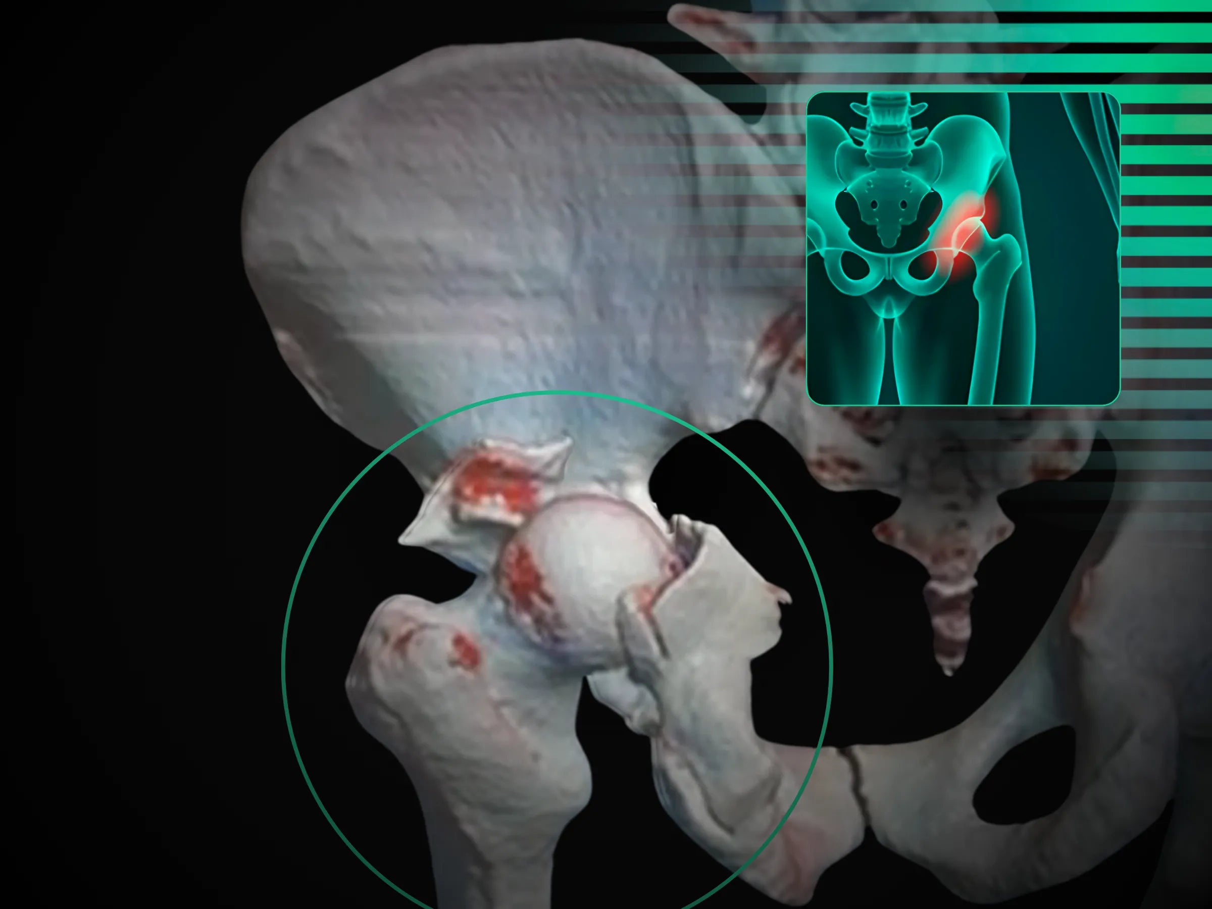 Fratura do Rebordo Posterior do Acetábulo com Luxação do Quadril