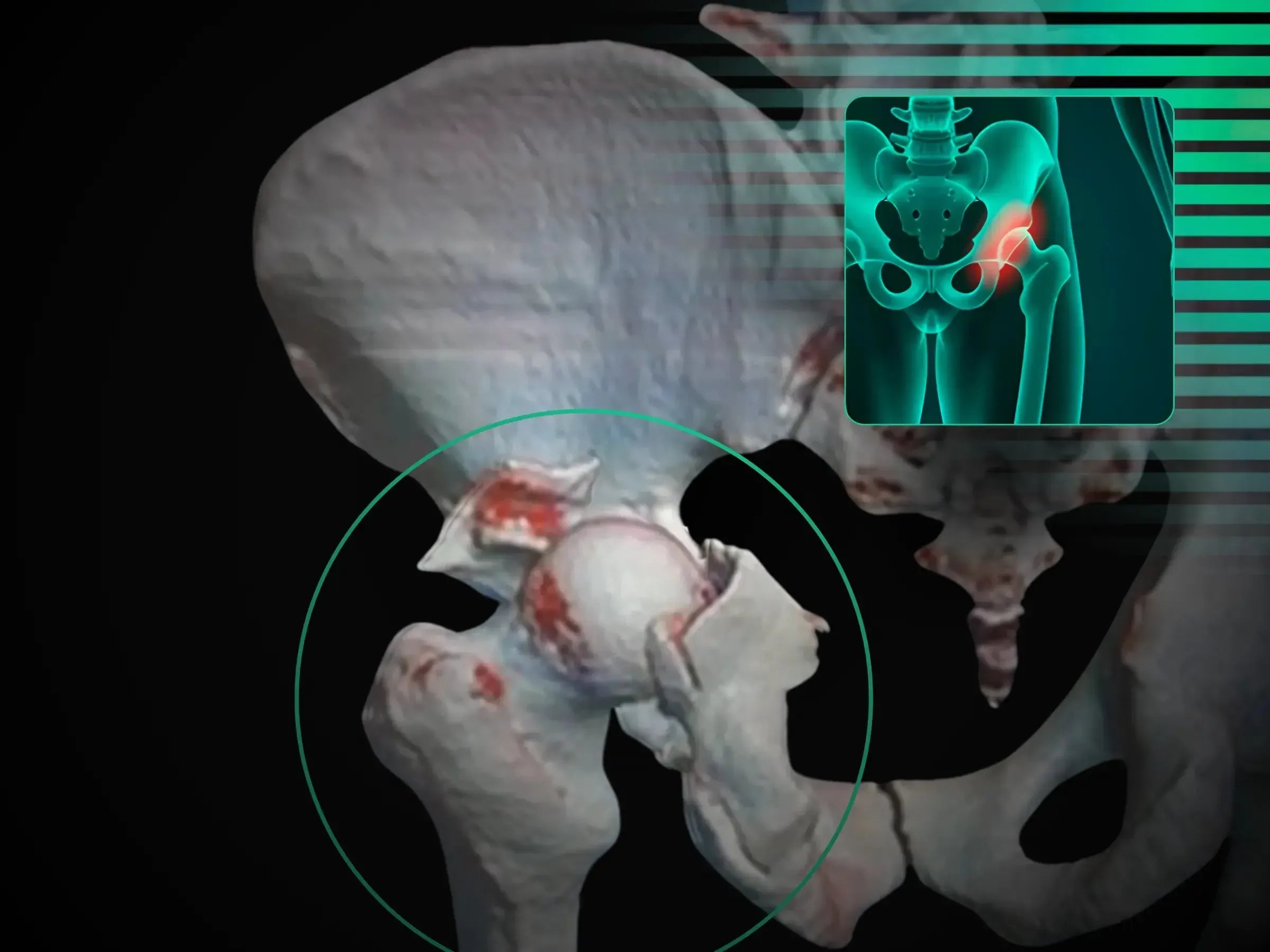 Fracture of the Posterior Acetabular Wall with Hip Dislocation