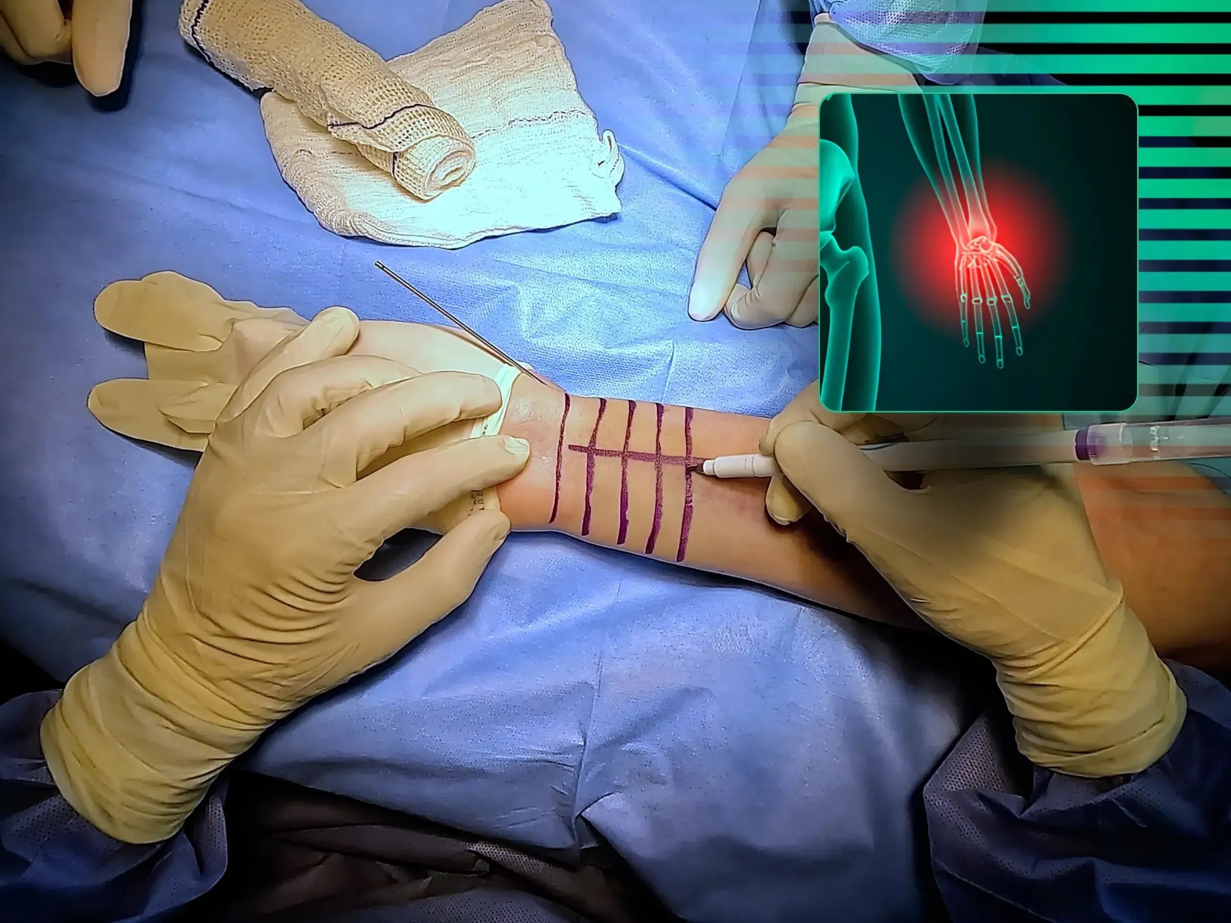 Distal Radius Fracture (Volar Approach)