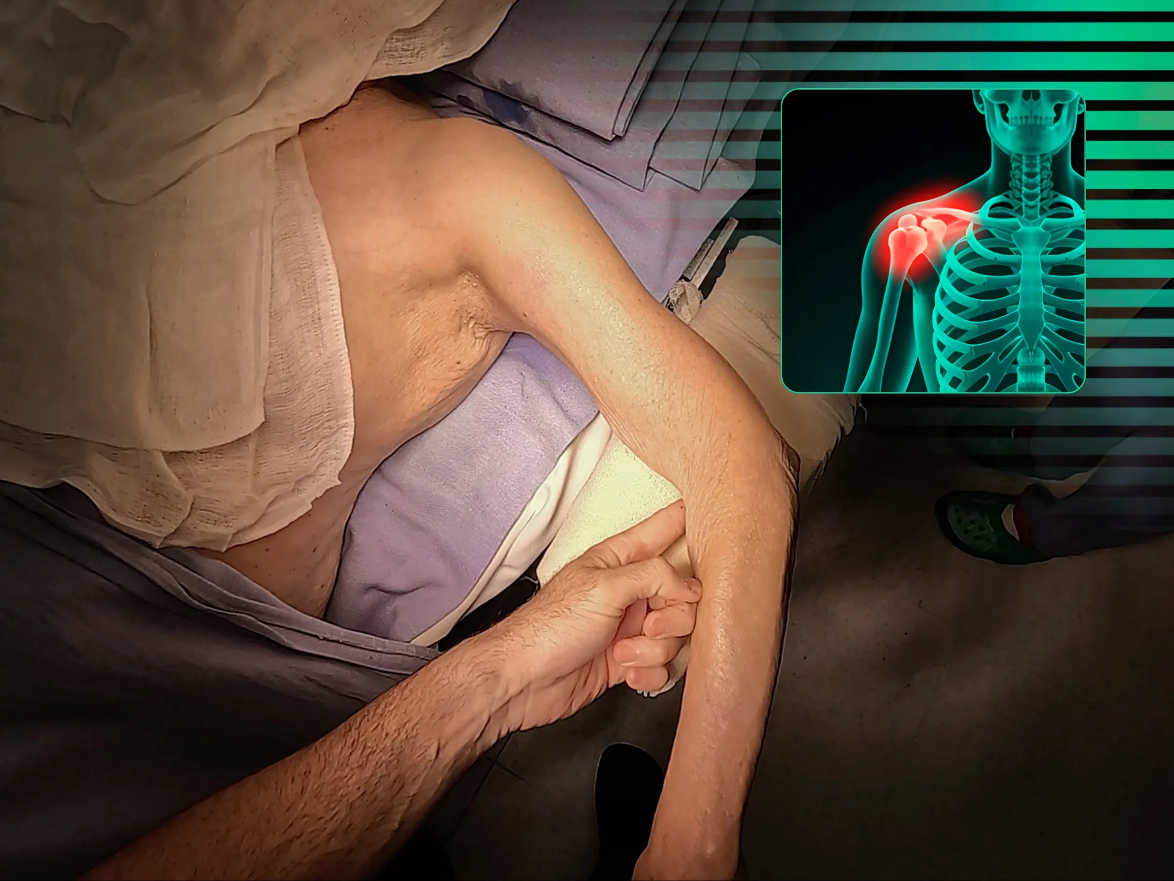 Fratura do Úmero Proximal com Placa (Acesso Deltopeitoral)