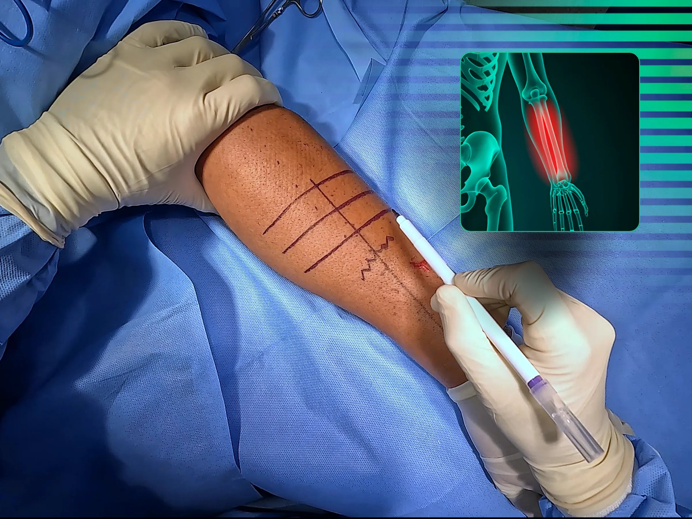 Fraturas Diafisárias do Rádio e da Ulna