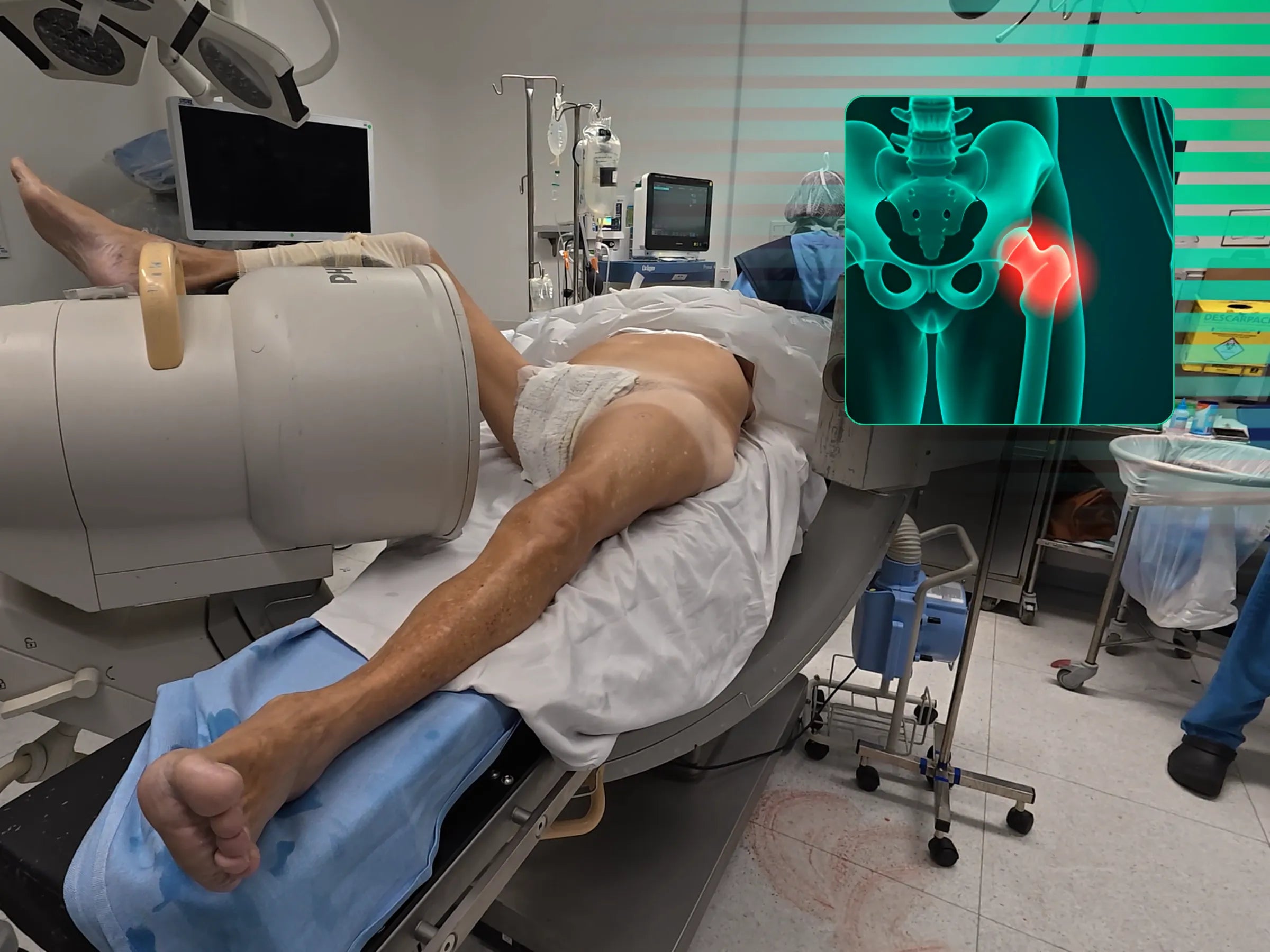 Proximal Femur Fractures Without Traction Table