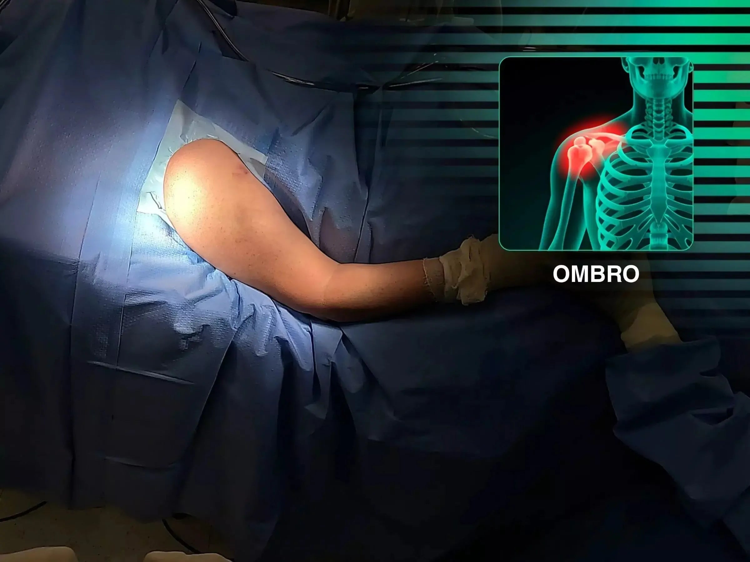 Haste Intramedular para Fratura do Úmero Proximal