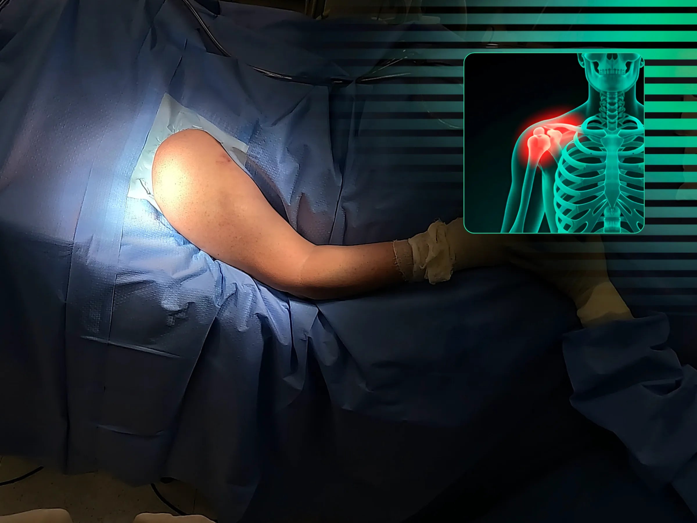 Intramedullary Rod for Proximal Humerus Fracture