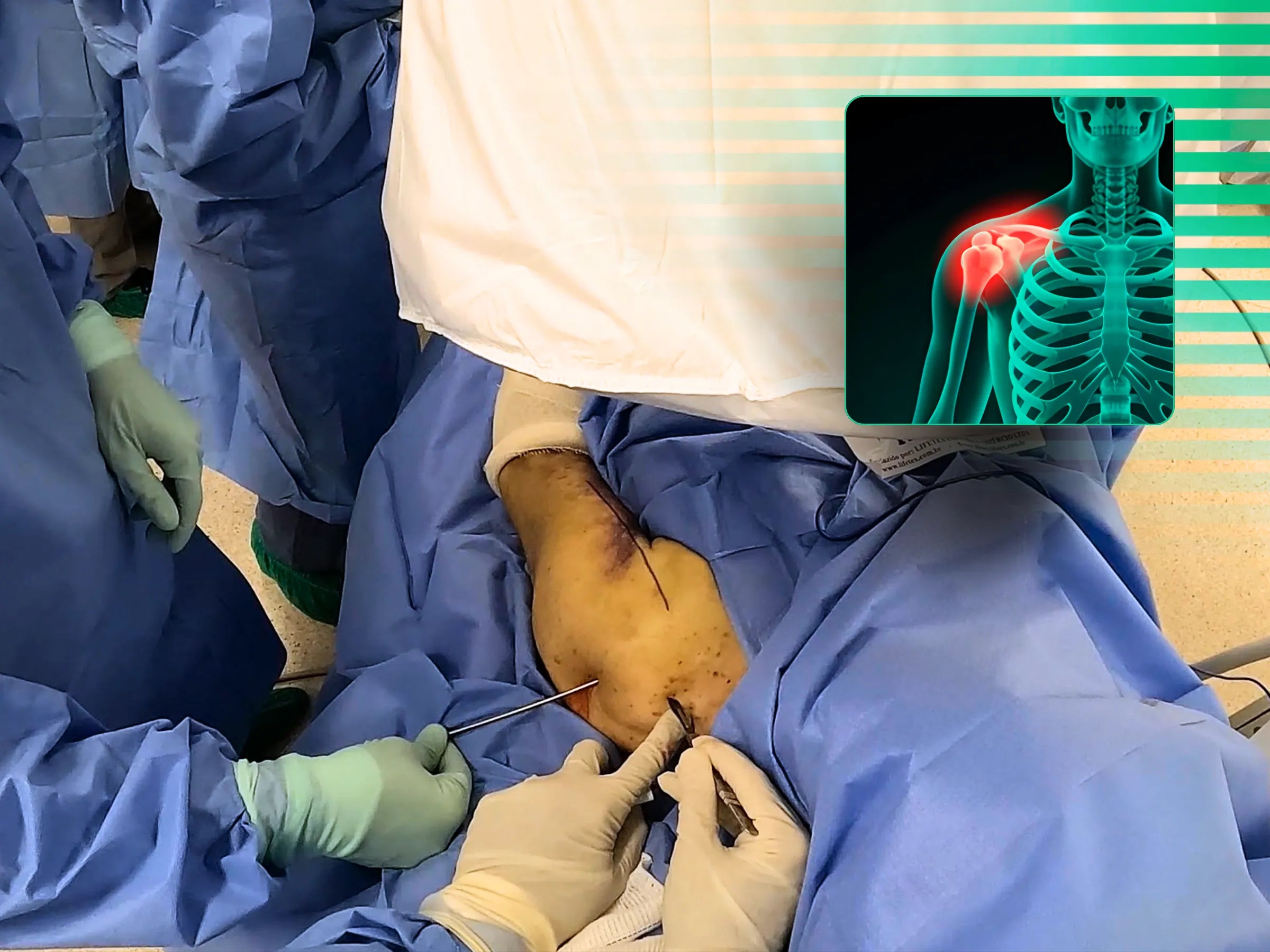 Haste Intramedular para Fratura do Úmero Proximal