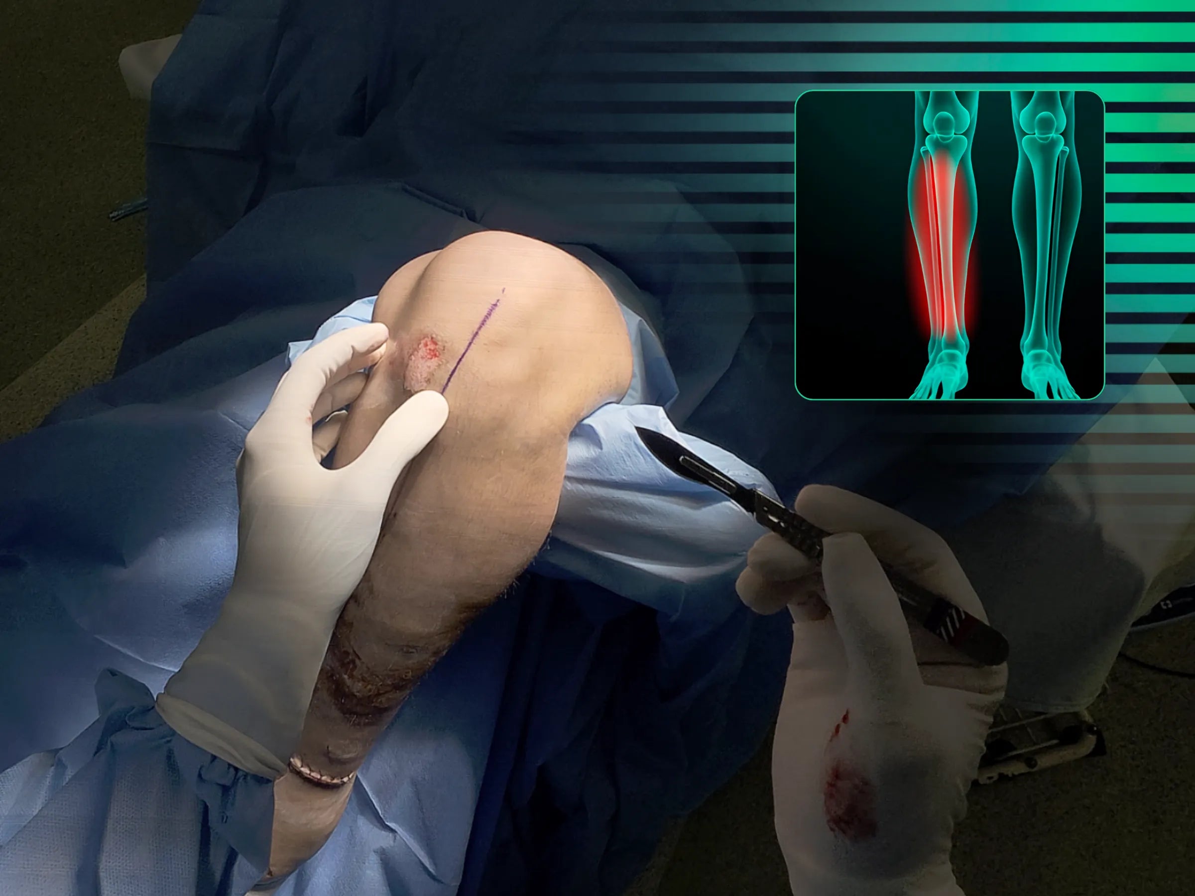 Haste Intramedular da Tíbia - Abordagem Infra-Patelar