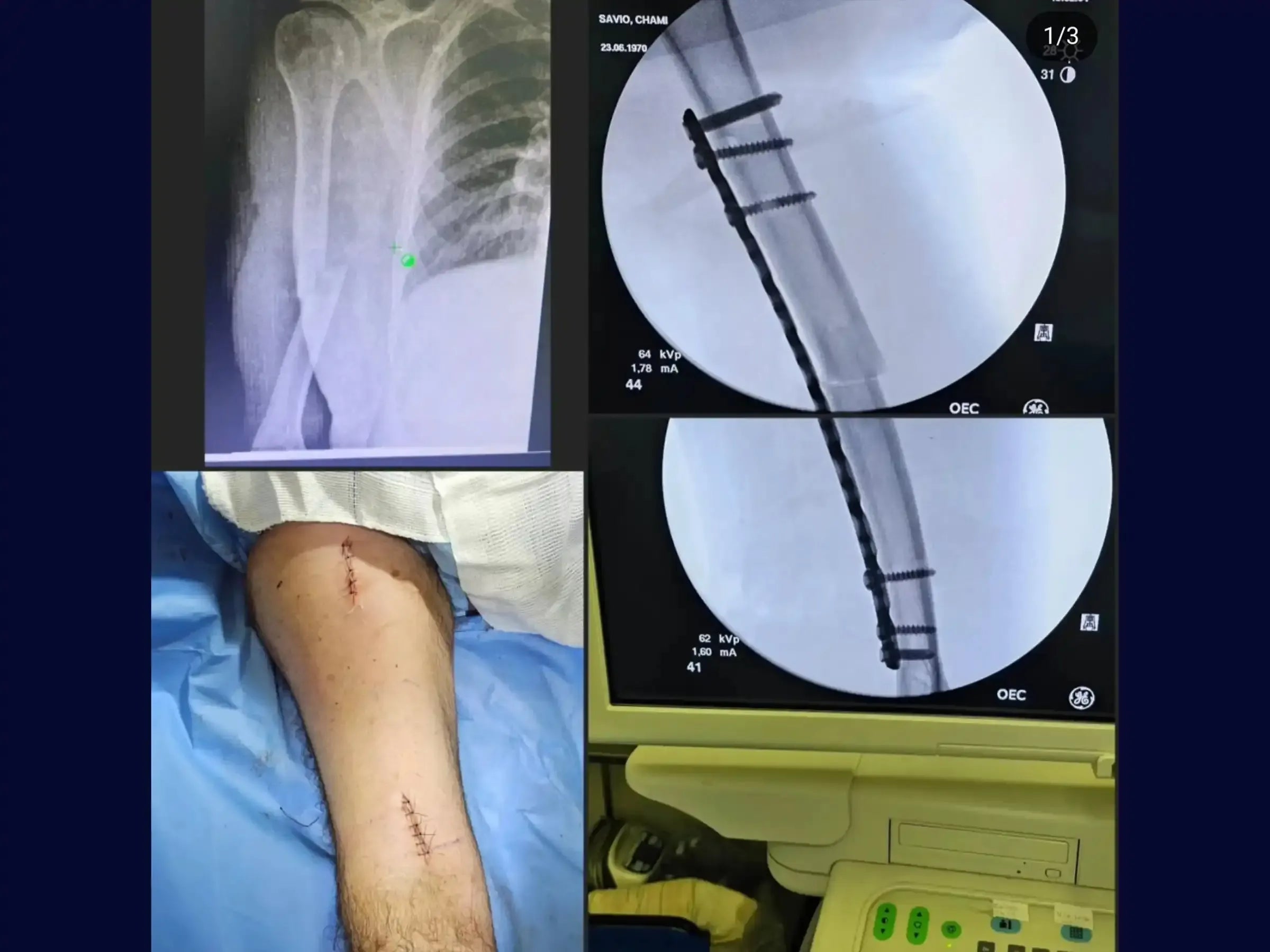 Humeral Diaphyseal Fracture with Bridge Plating