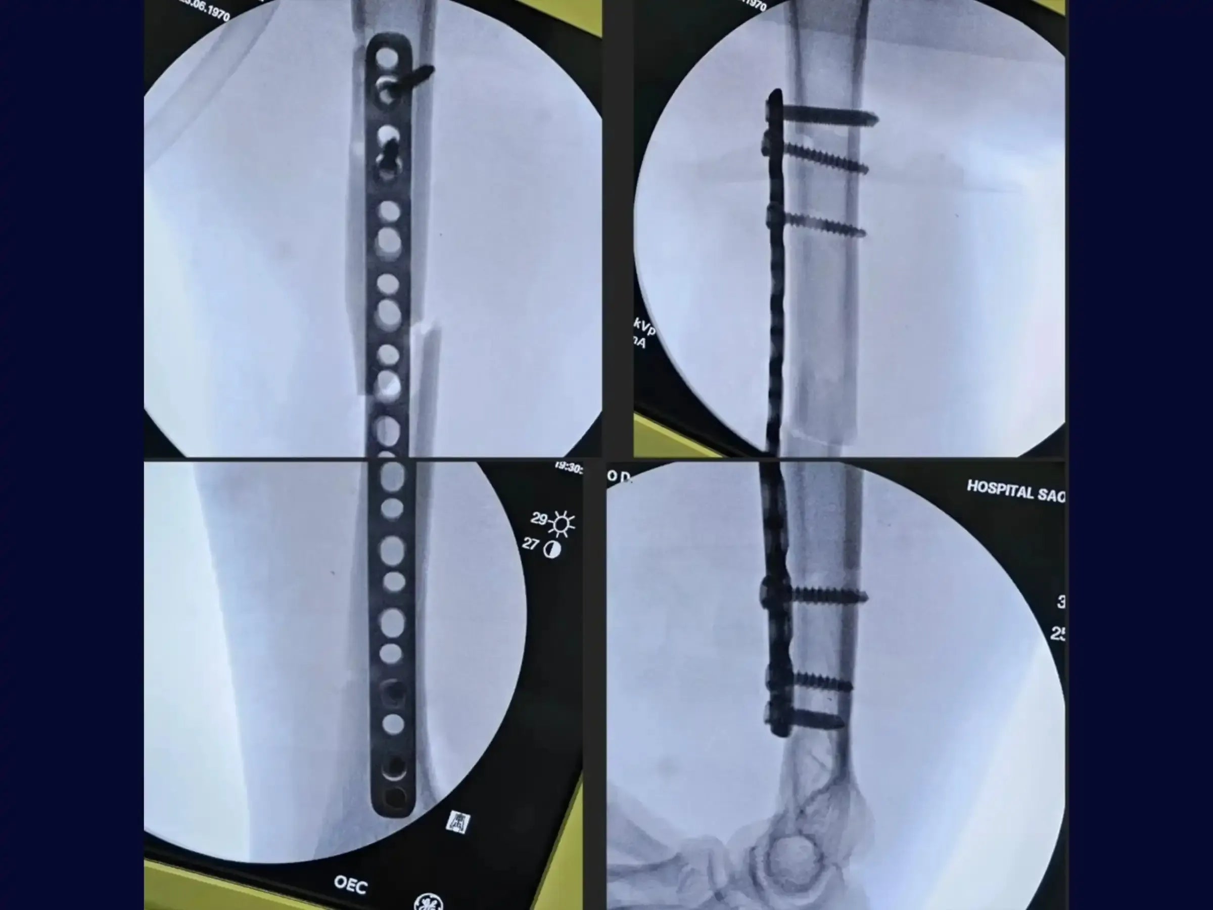 Humeral Diaphyseal Fracture with Bridge Plating