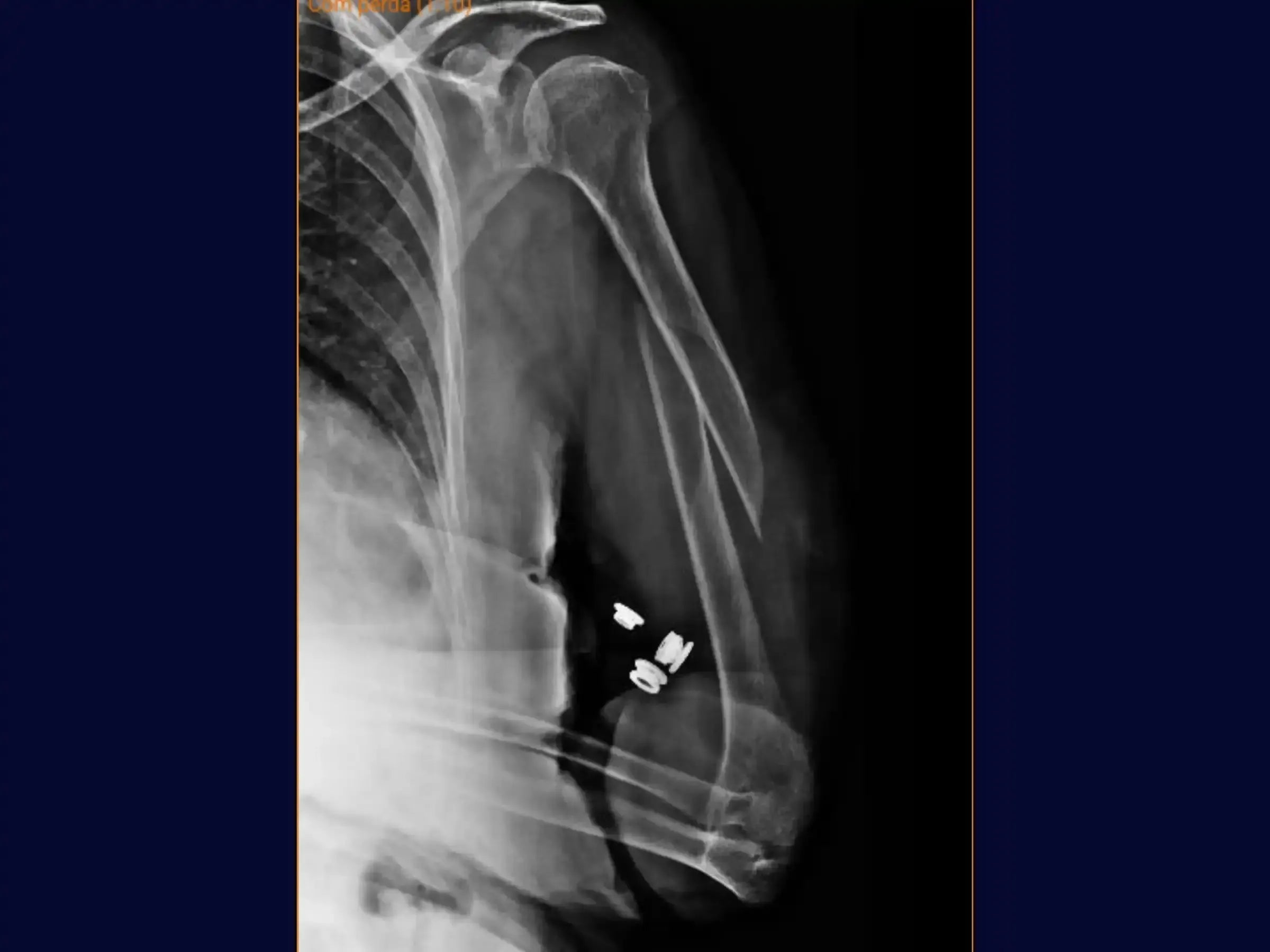 Humeral Diaphyseal Fracture with Intramedullary Nail