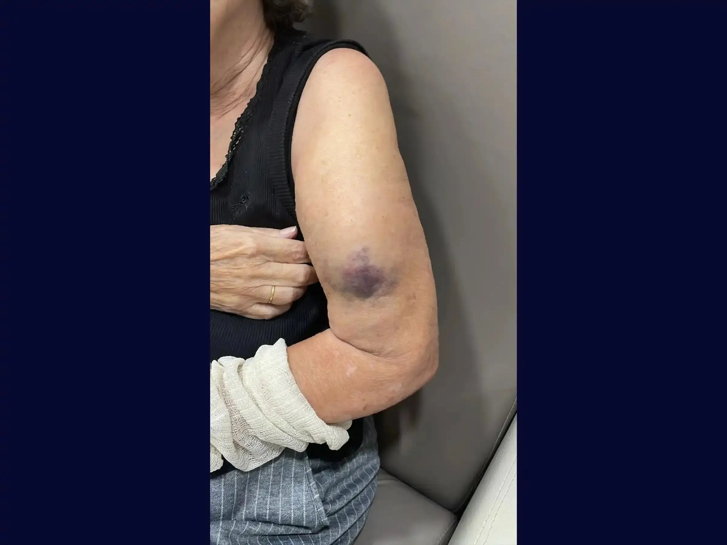 Humeral Diaphyseal Fracture with Intramedullary Nail