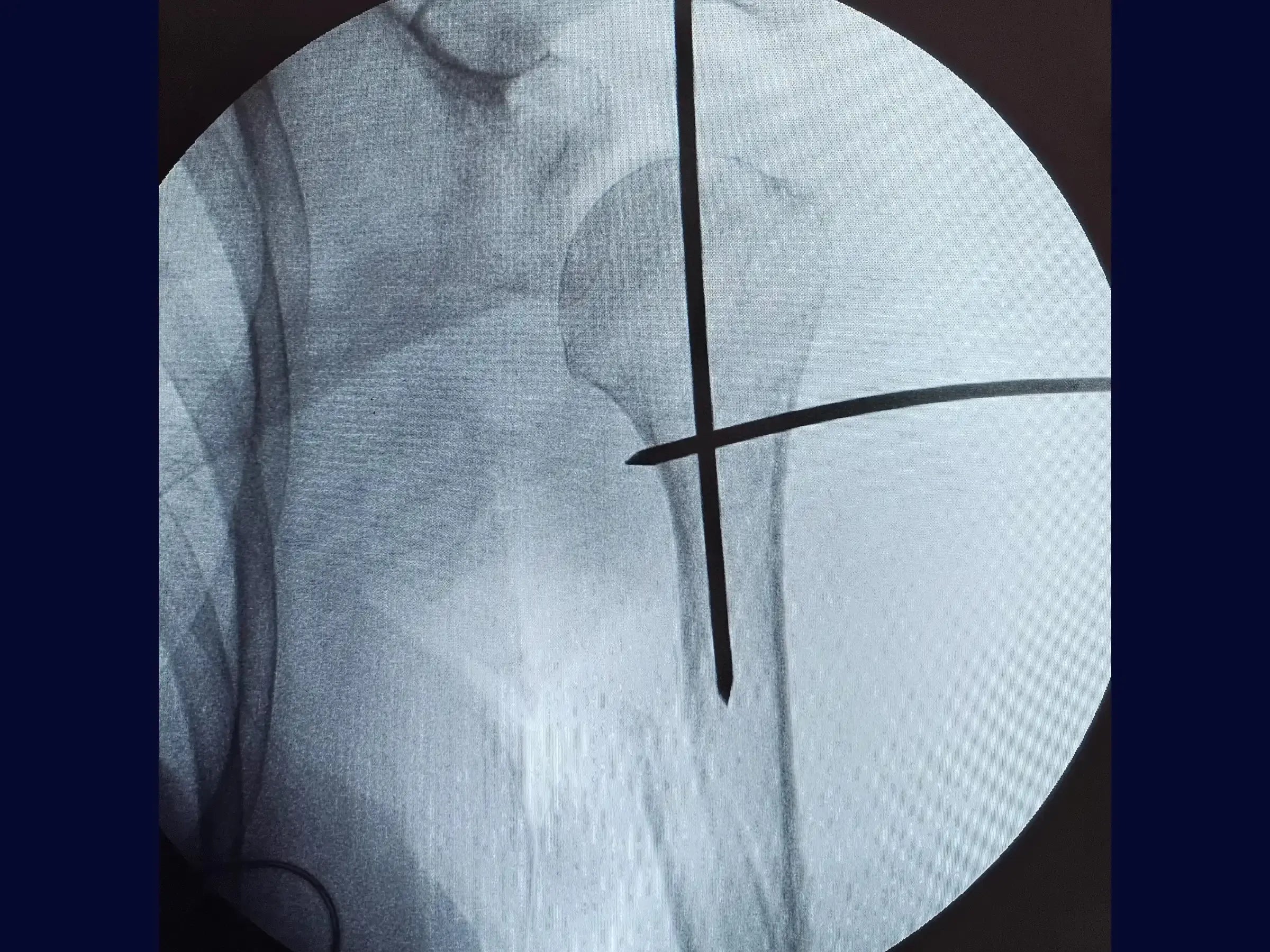Humeral Diaphyseal Fracture with Intramedullary Nail