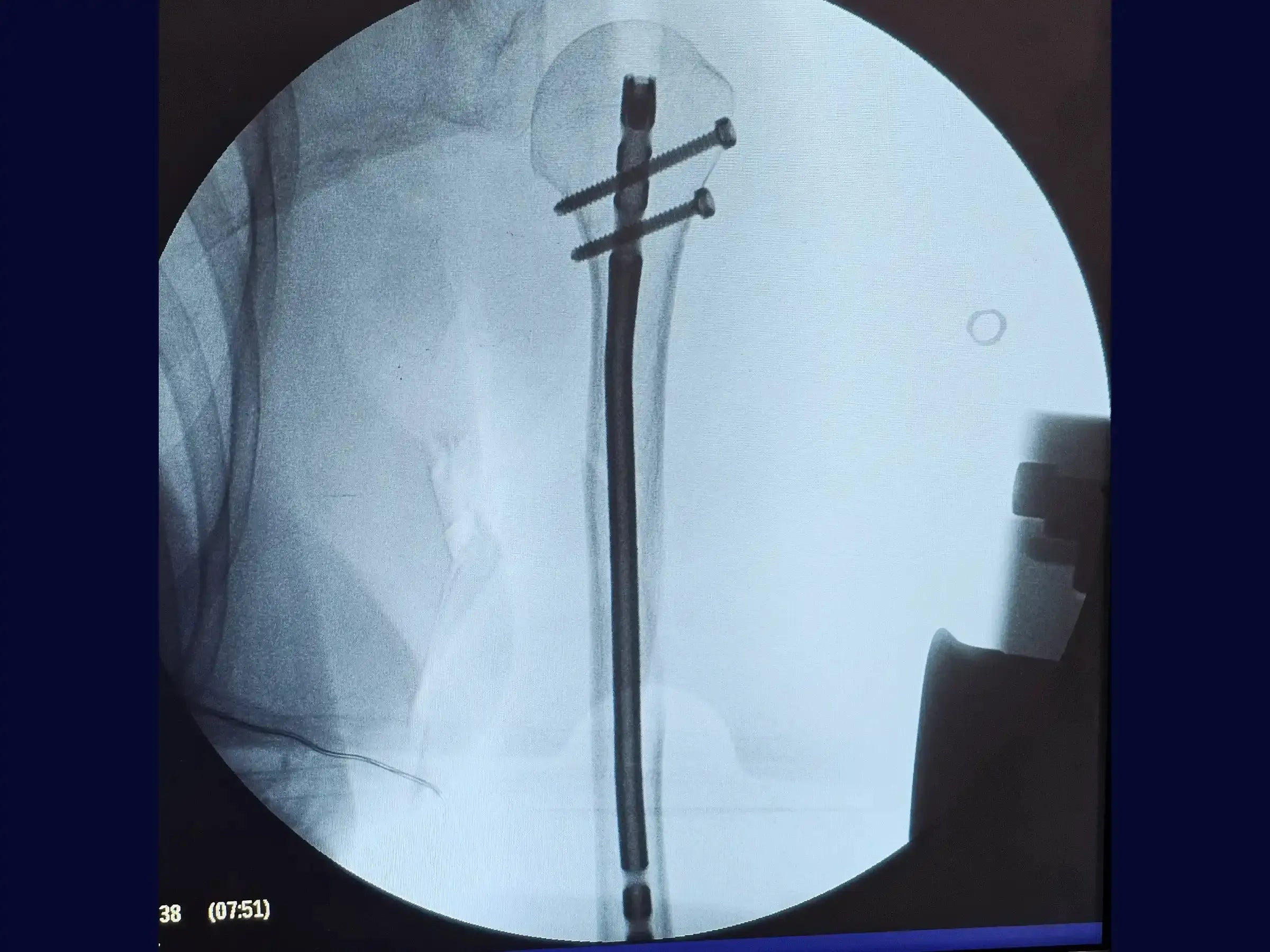 Humeral Diaphyseal Fracture with Intramedullary Nail