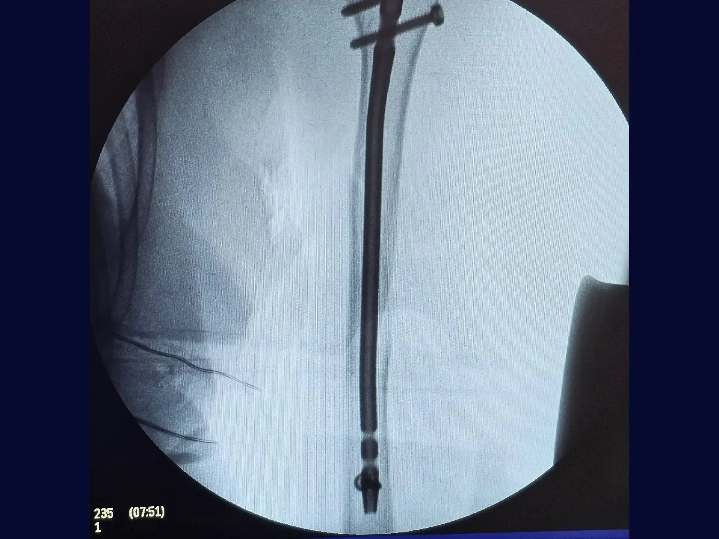 Humeral Diaphyseal Fracture with Intramedullary Nail