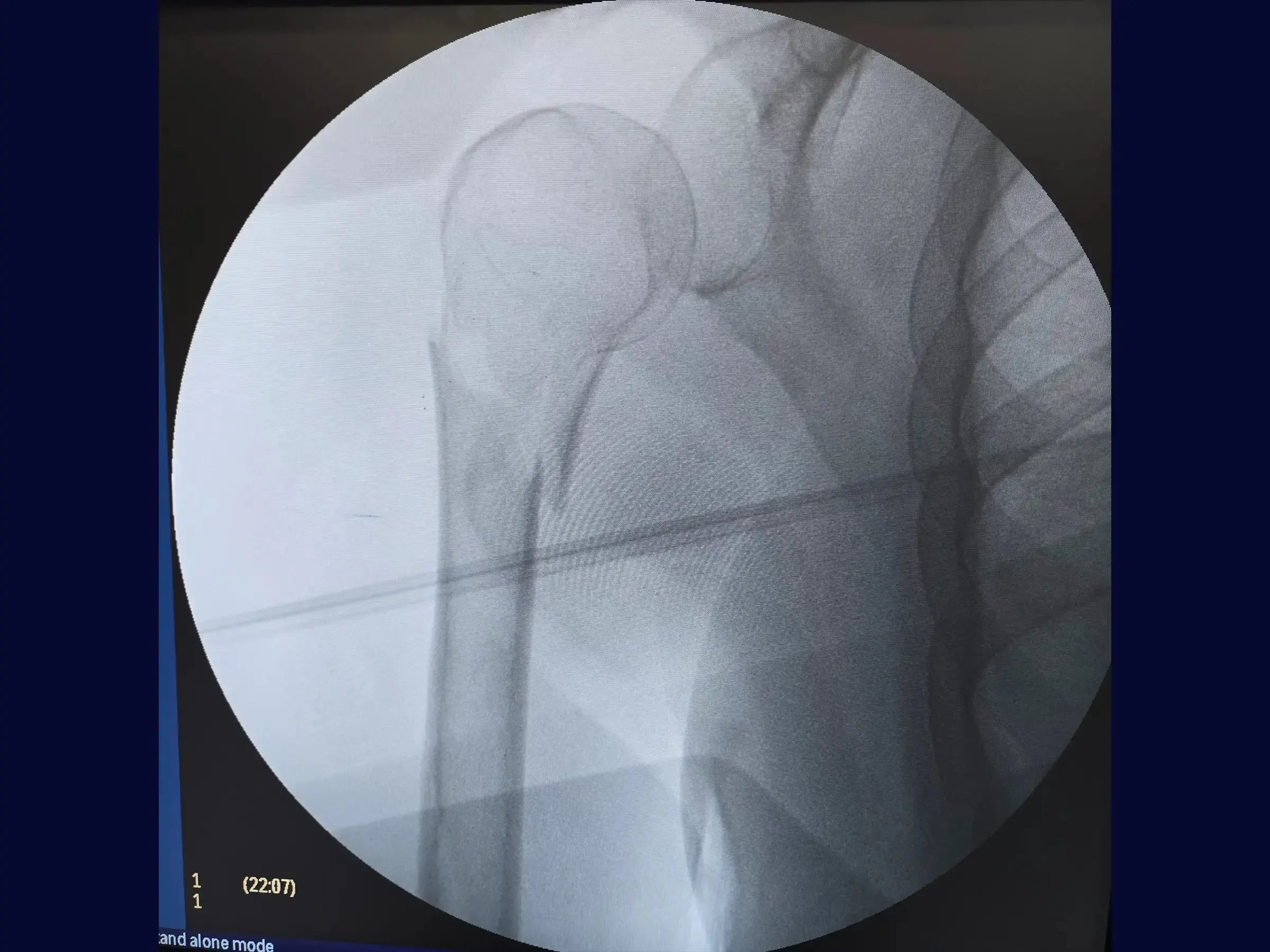 Intramedullary Nail for Proximal Humerus Fracture