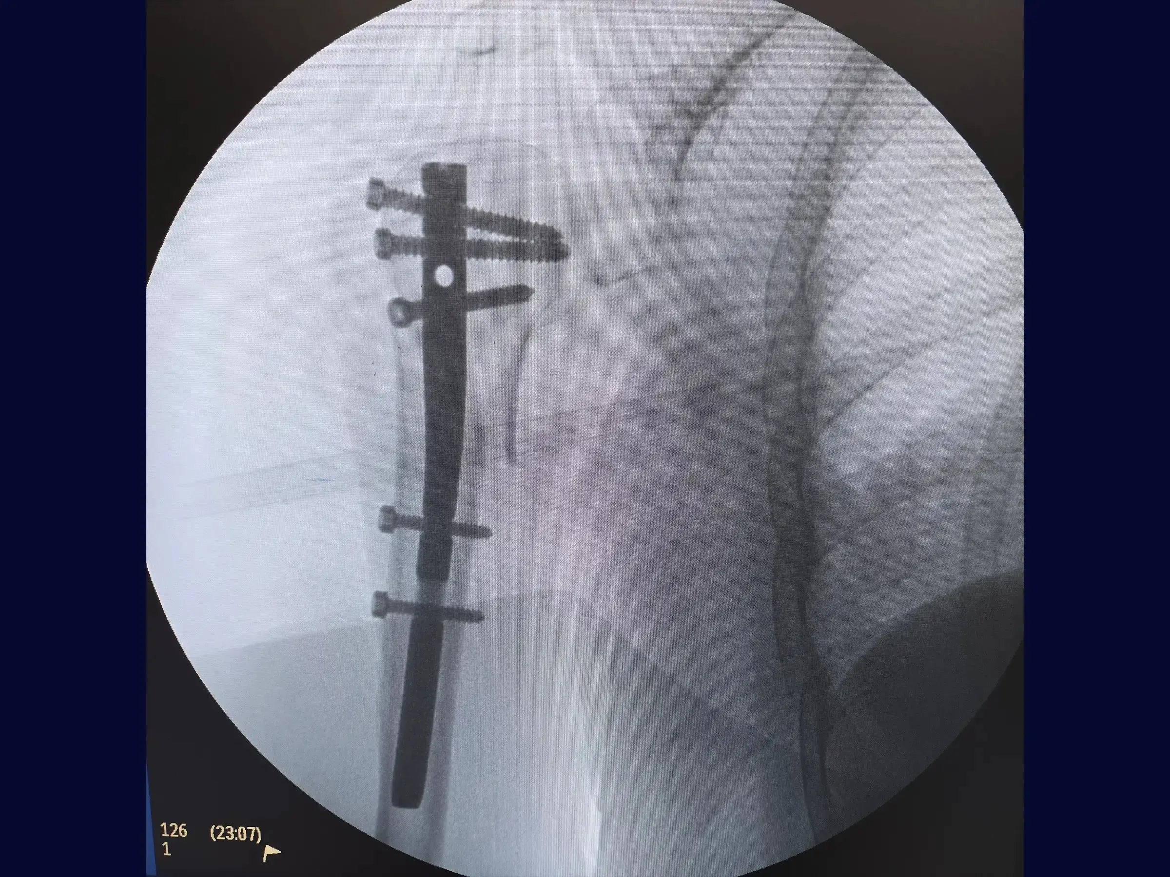 Intramedullary Nail for Proximal Humerus Fracture