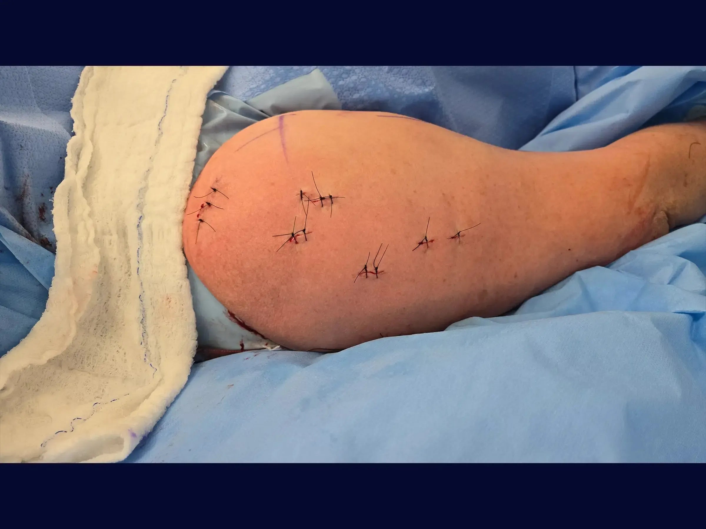 Intramedullary Nail for Proximal Humerus Fracture