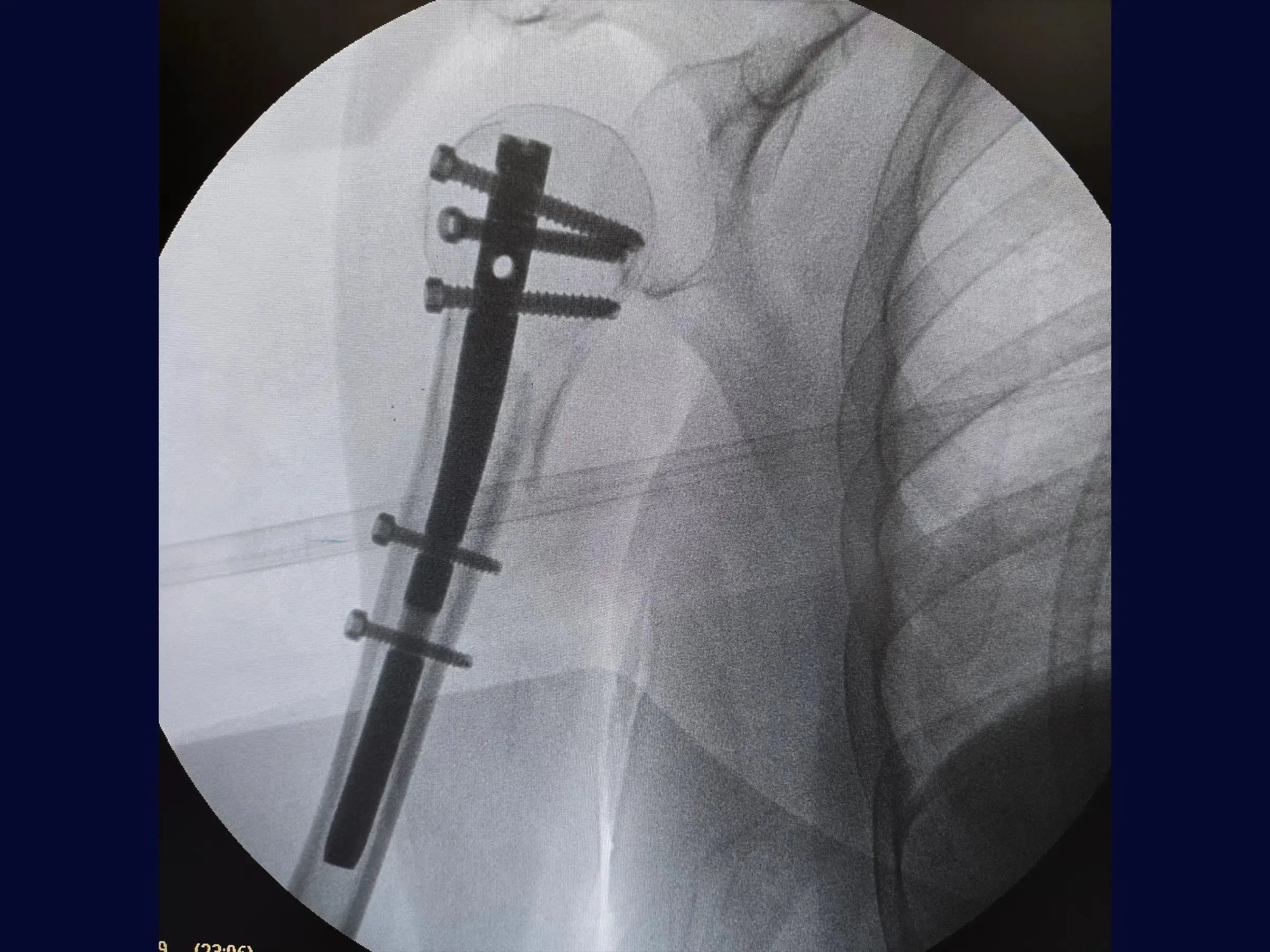 Intramedullary Nail for Proximal Humerus Fracture