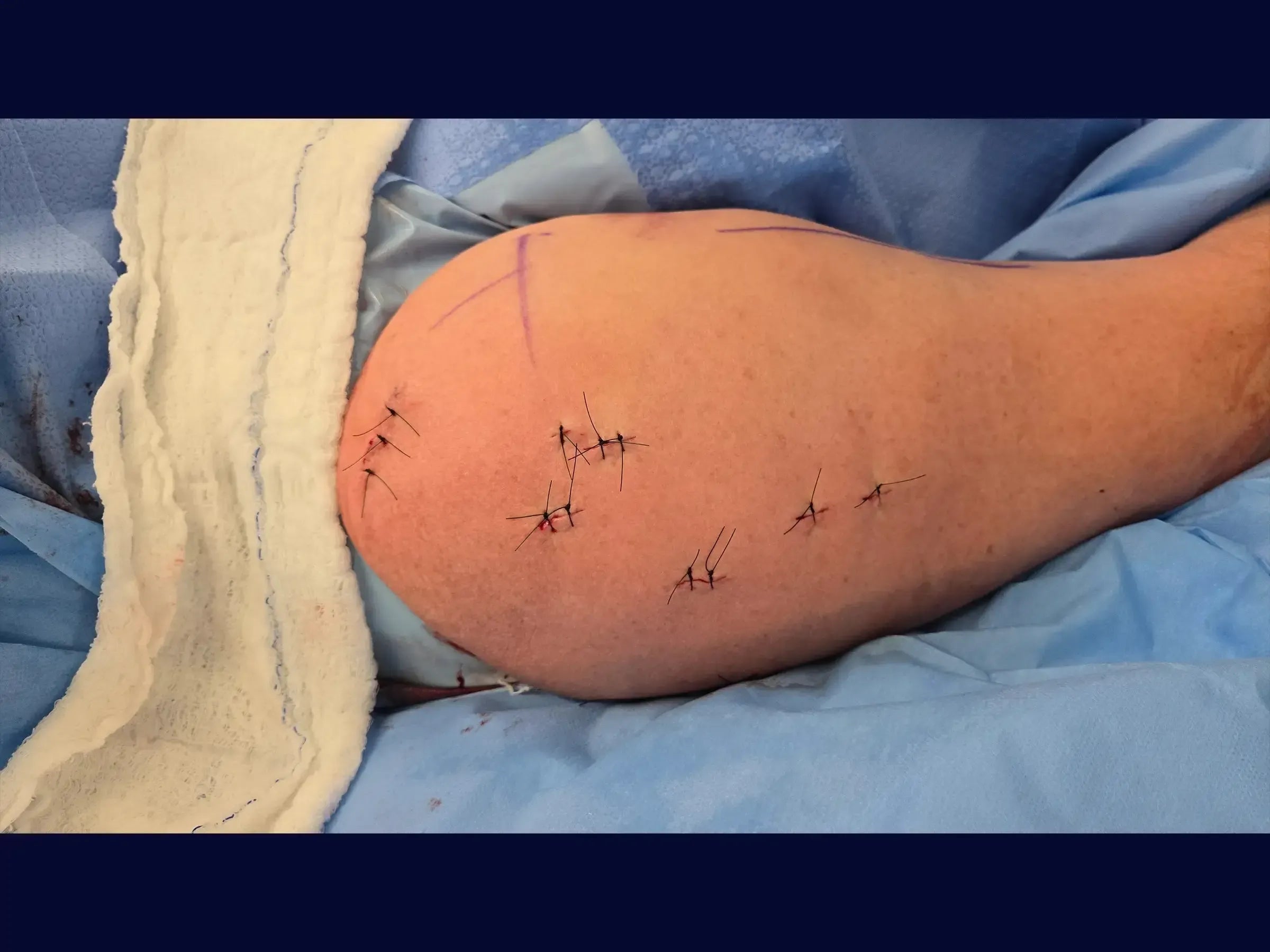 Intramedullary Nail for Proximal Humerus Fracture