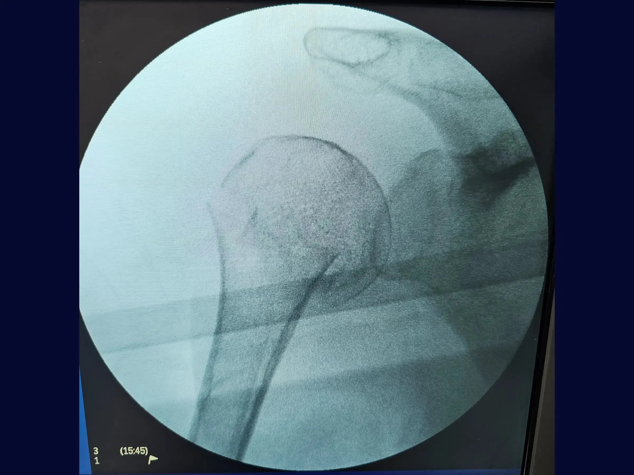 Intramedullary Nailing for Proximal Humerus Fracture
