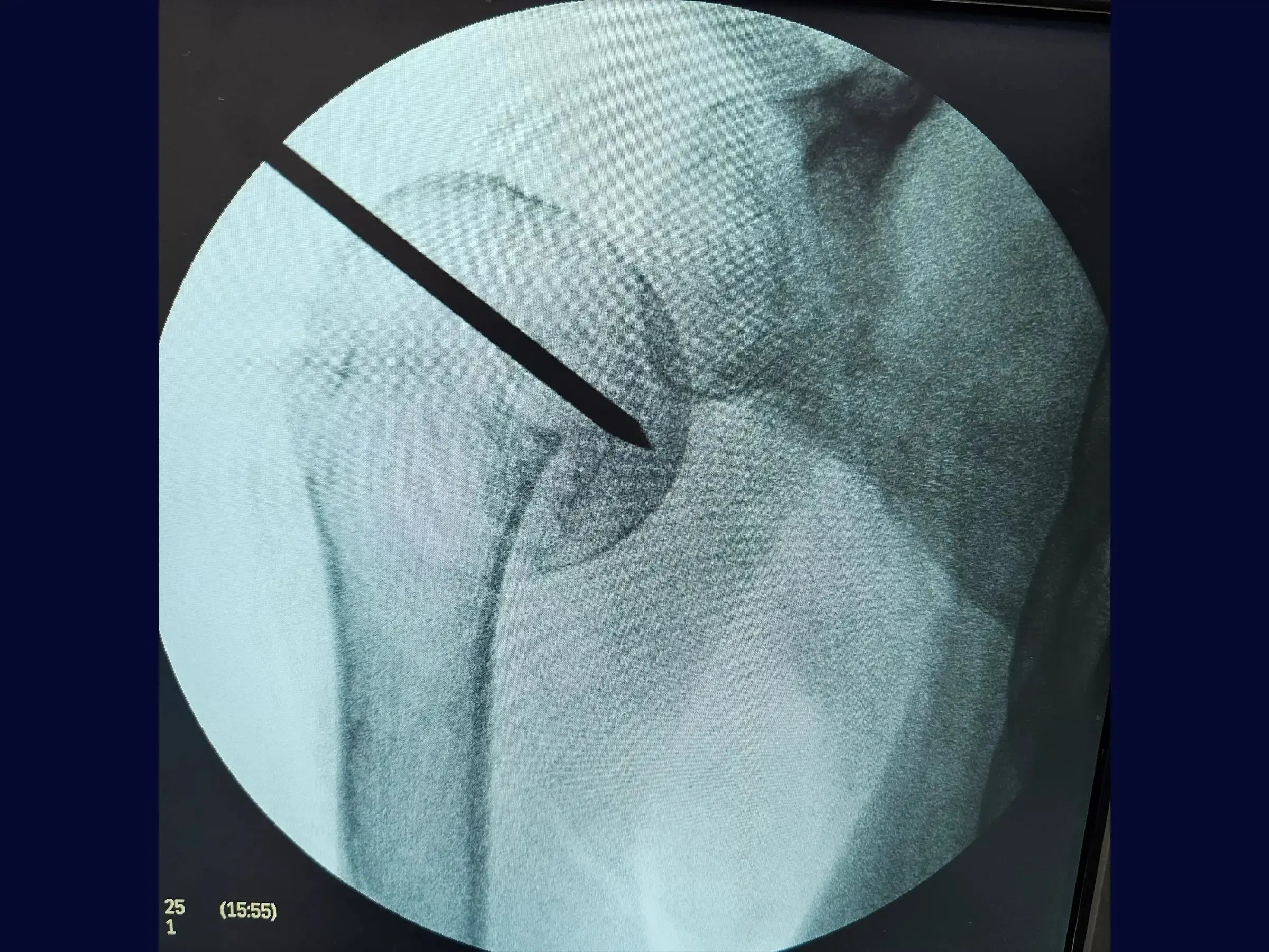 Intramedullary Nailing for Proximal Humerus Fracture
