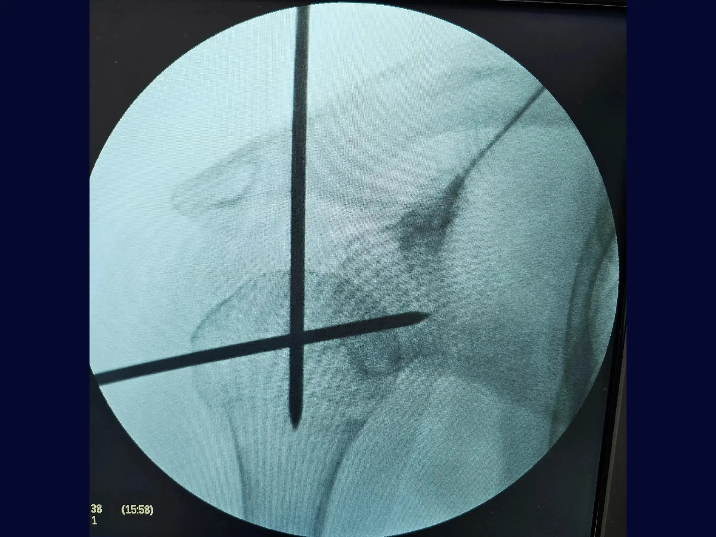 Intramedullary Nailing for Proximal Humerus Fracture