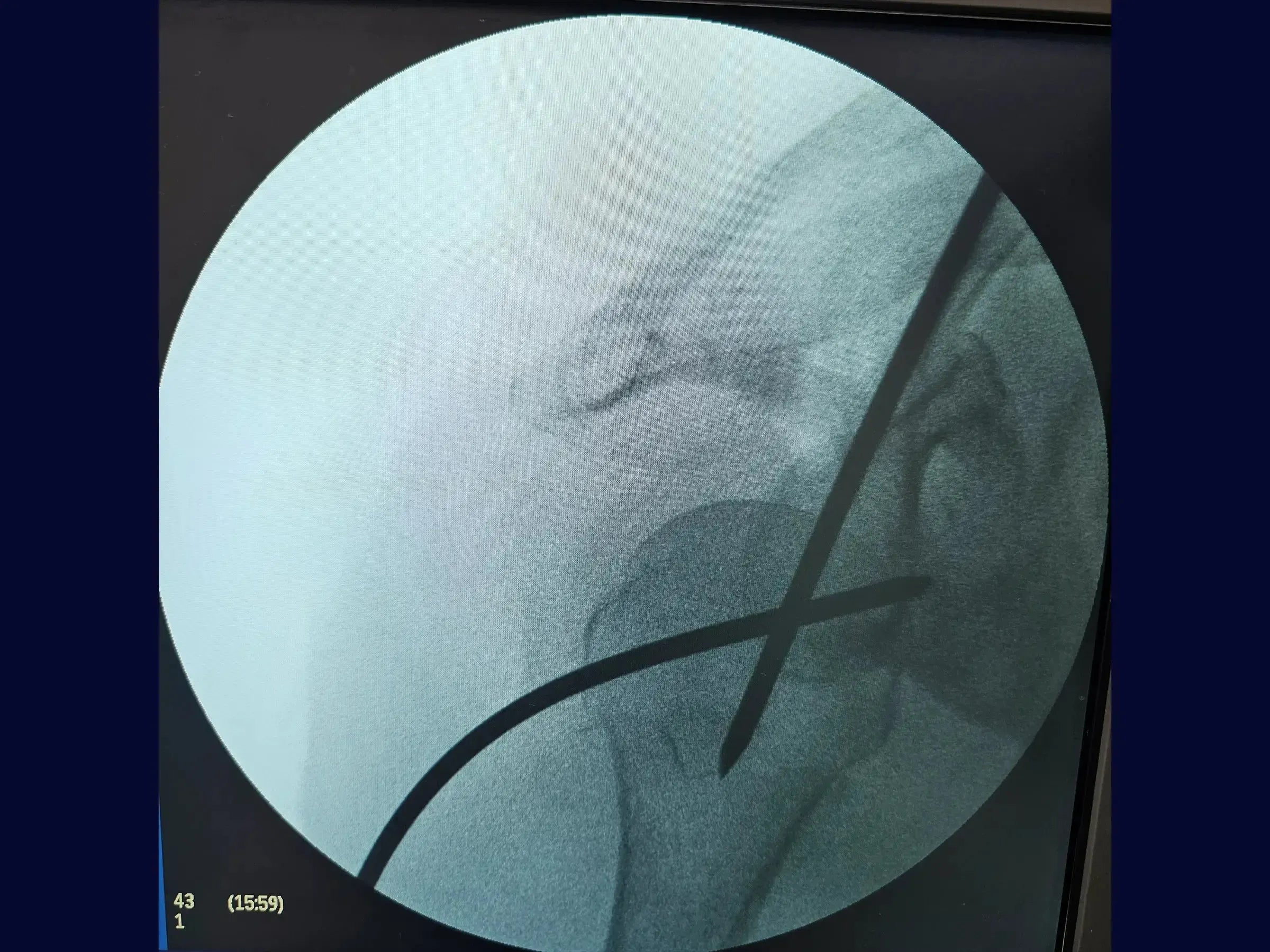 Intramedullary Nailing for Proximal Humerus Fracture