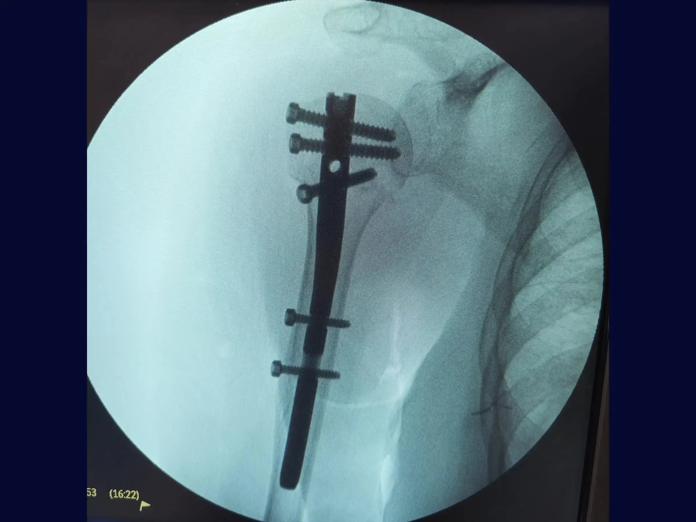 Intramedullary Nailing for Proximal Humerus Fracture