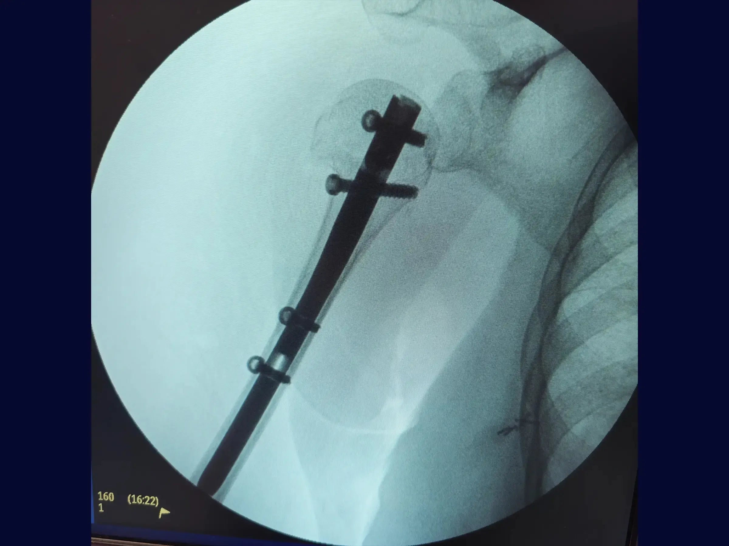 Intramedullary Nailing for Proximal Humerus Fracture