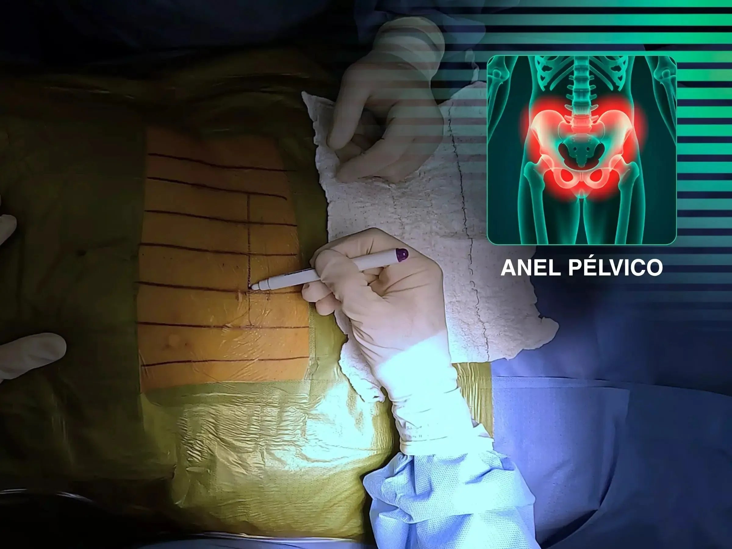 Lesão do Anel Pélvico "Open Book" (Luxação da Sínfise Púbica)
