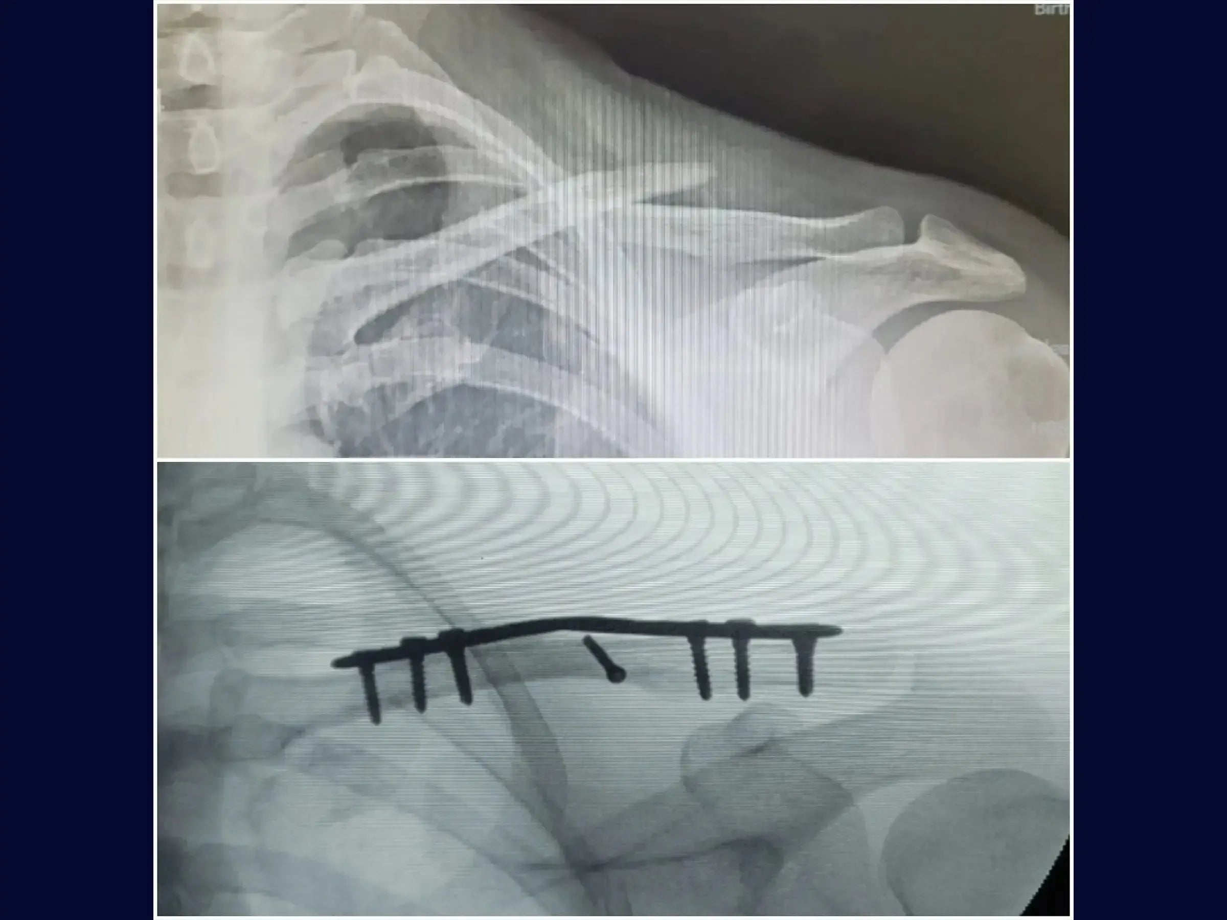 Minimally Invasive Osteosynthesis of Clavicle Fracture (Bridge Plating Technique)