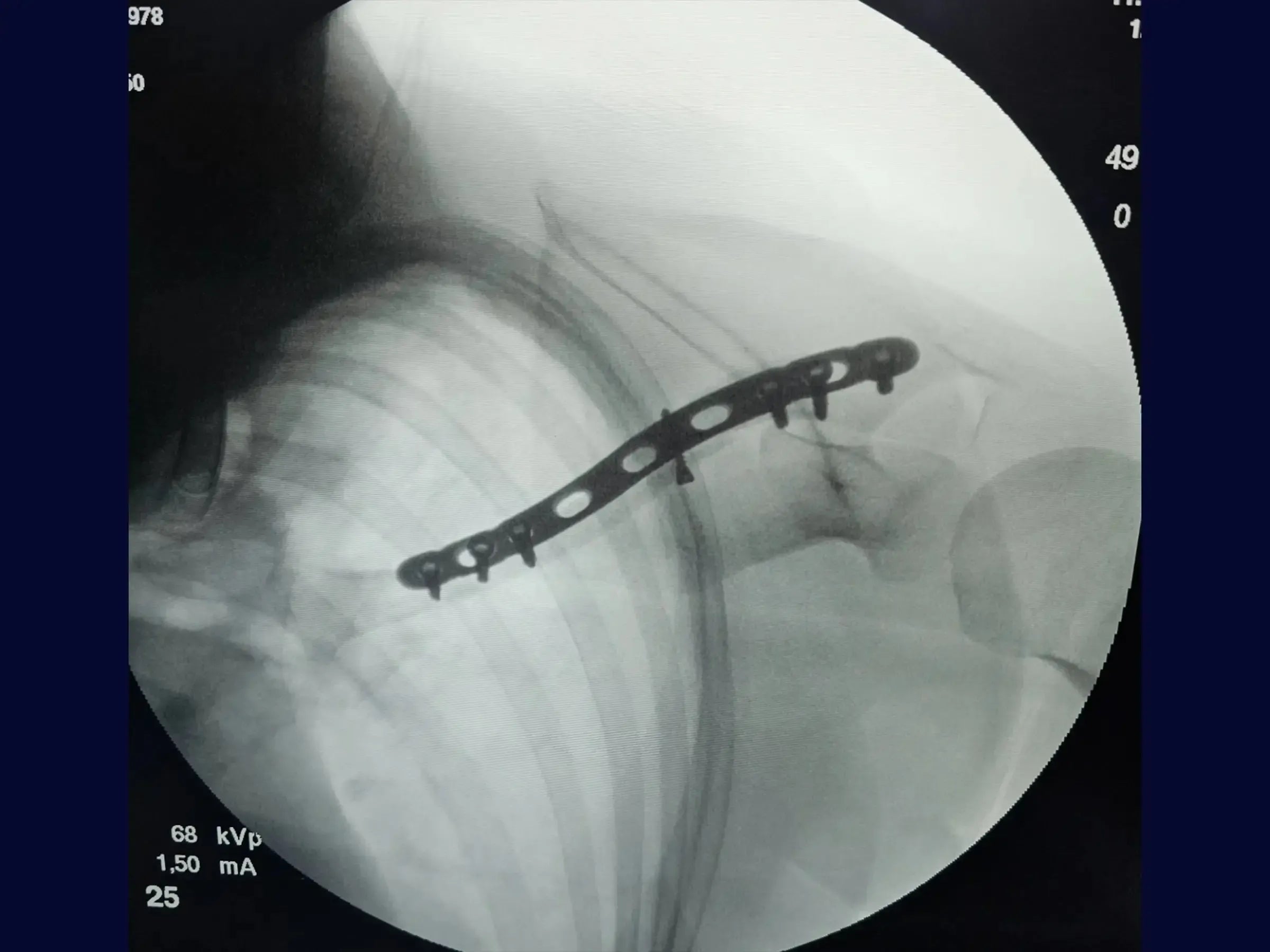 Minimally Invasive Osteosynthesis of Clavicle Fracture (Bridge Plating Technique)