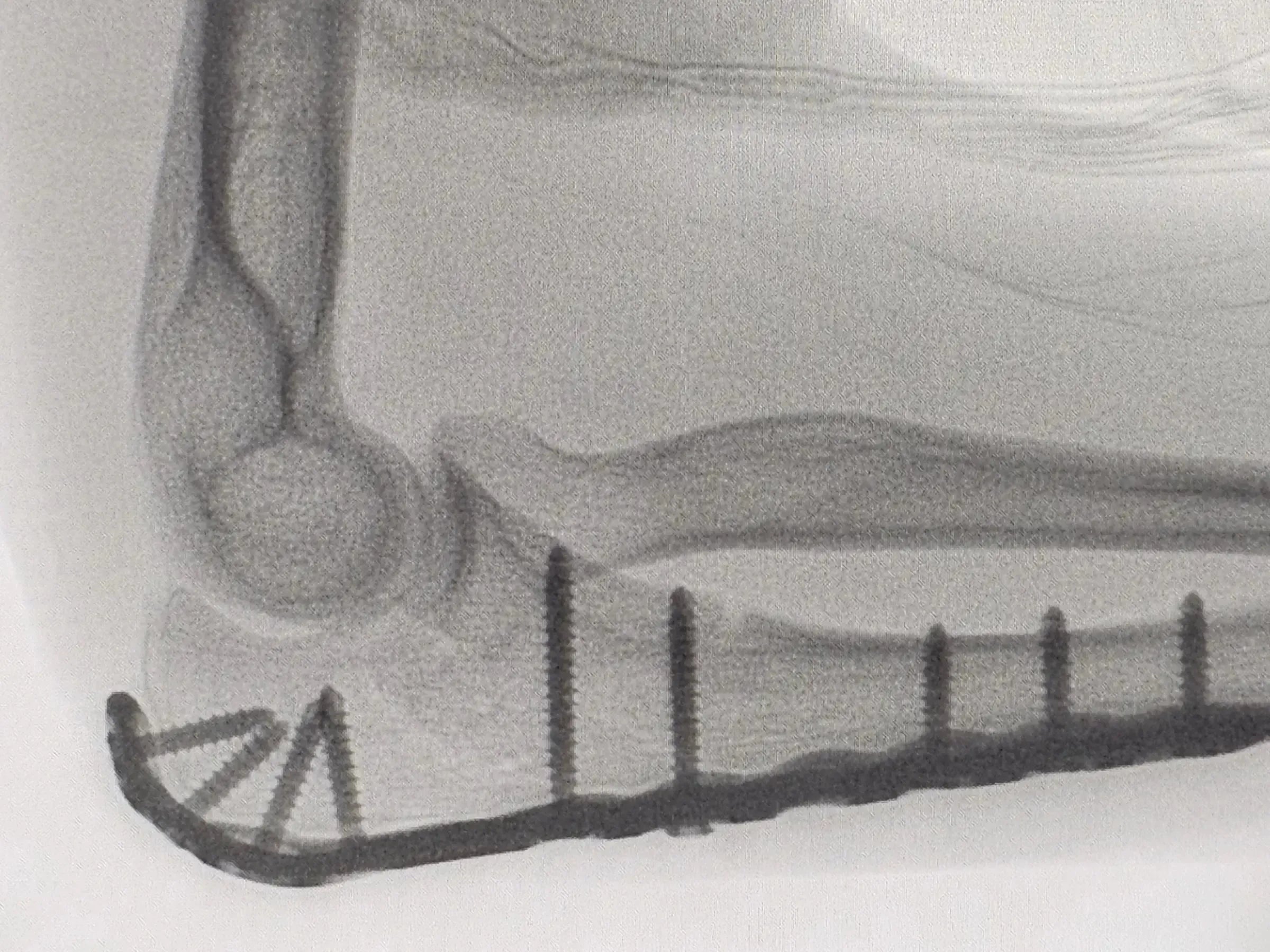 Minimally Invasive Osteosynthesis of Olecranon Fractures