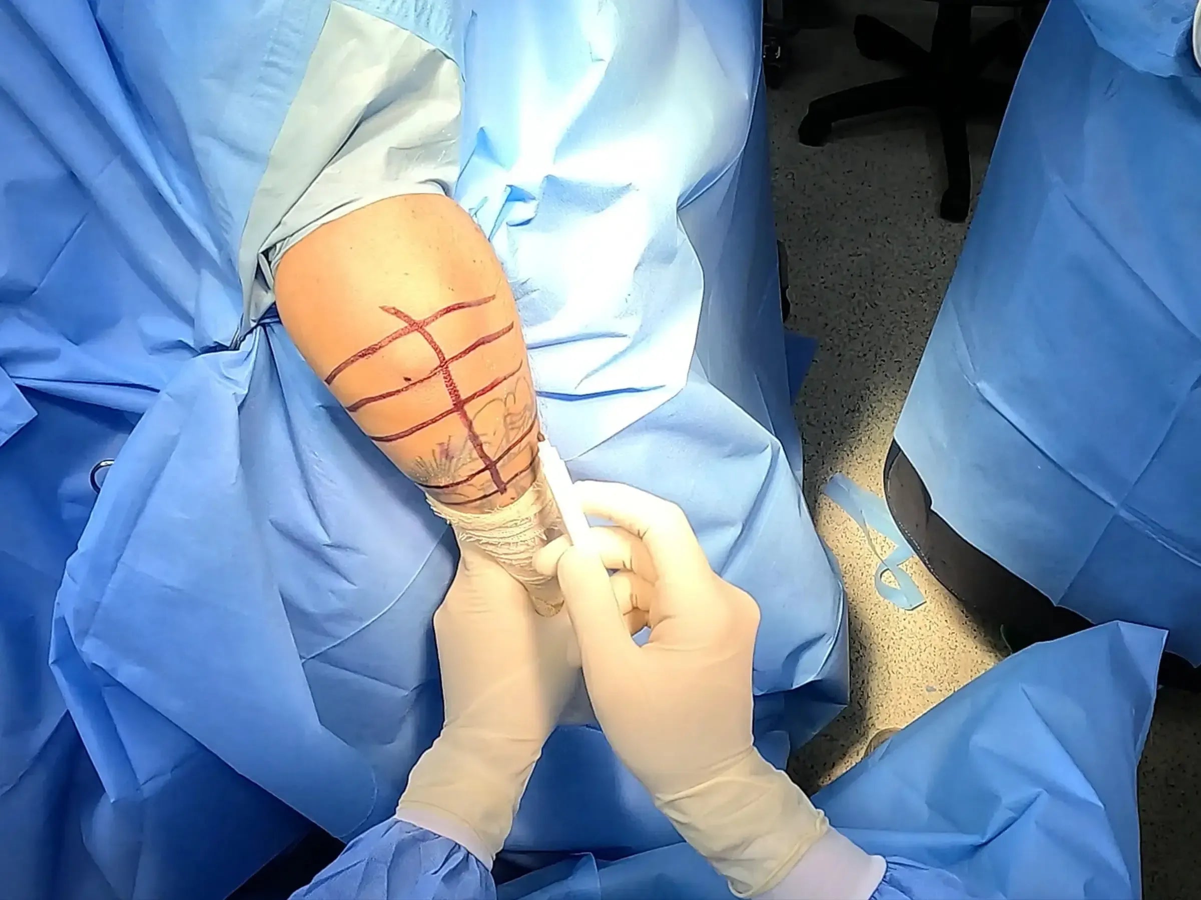 Minimally Invasive Osteosynthesis of Olecranon Fractures