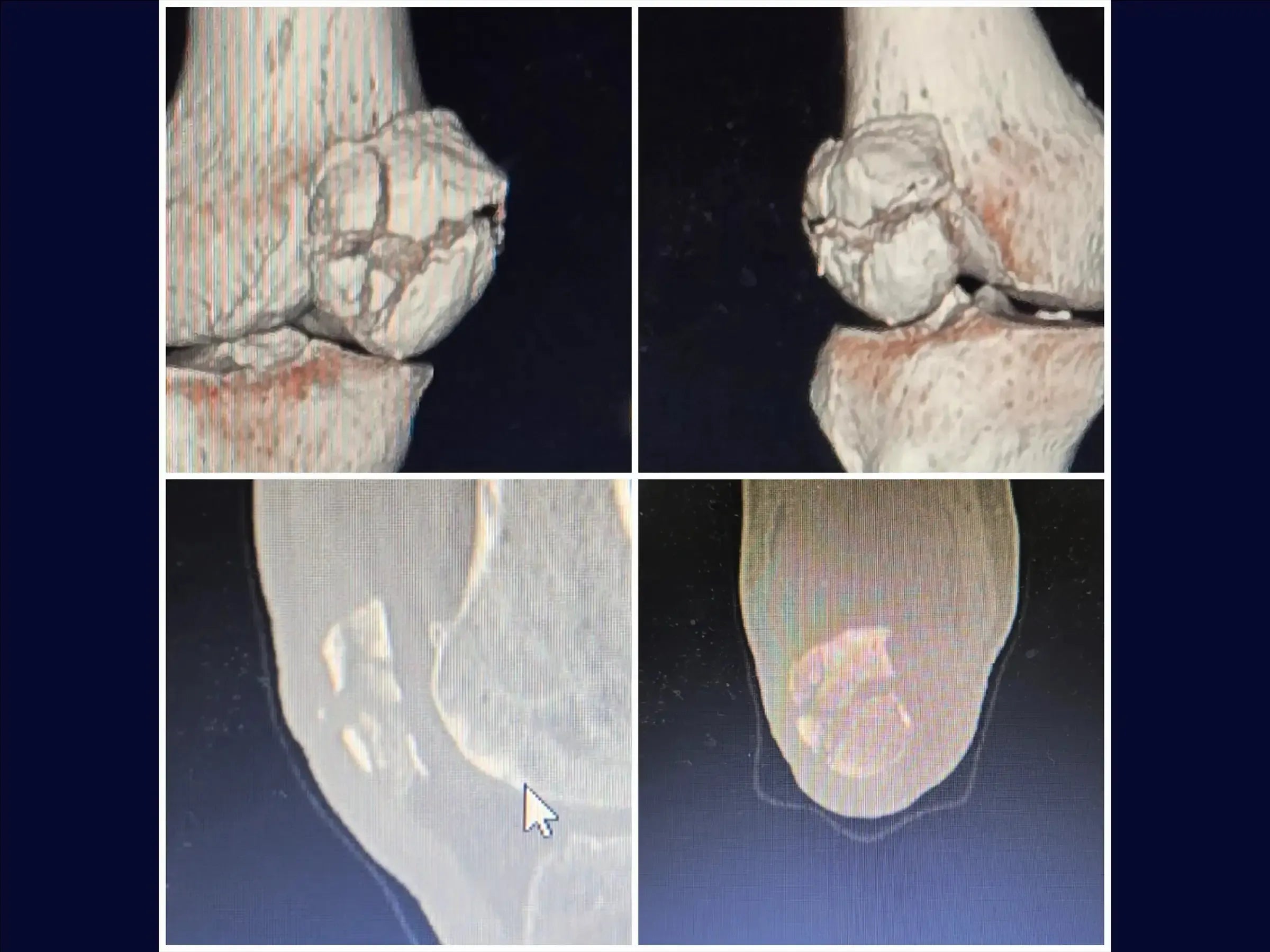 Multi-fragmentary Patella Fracture