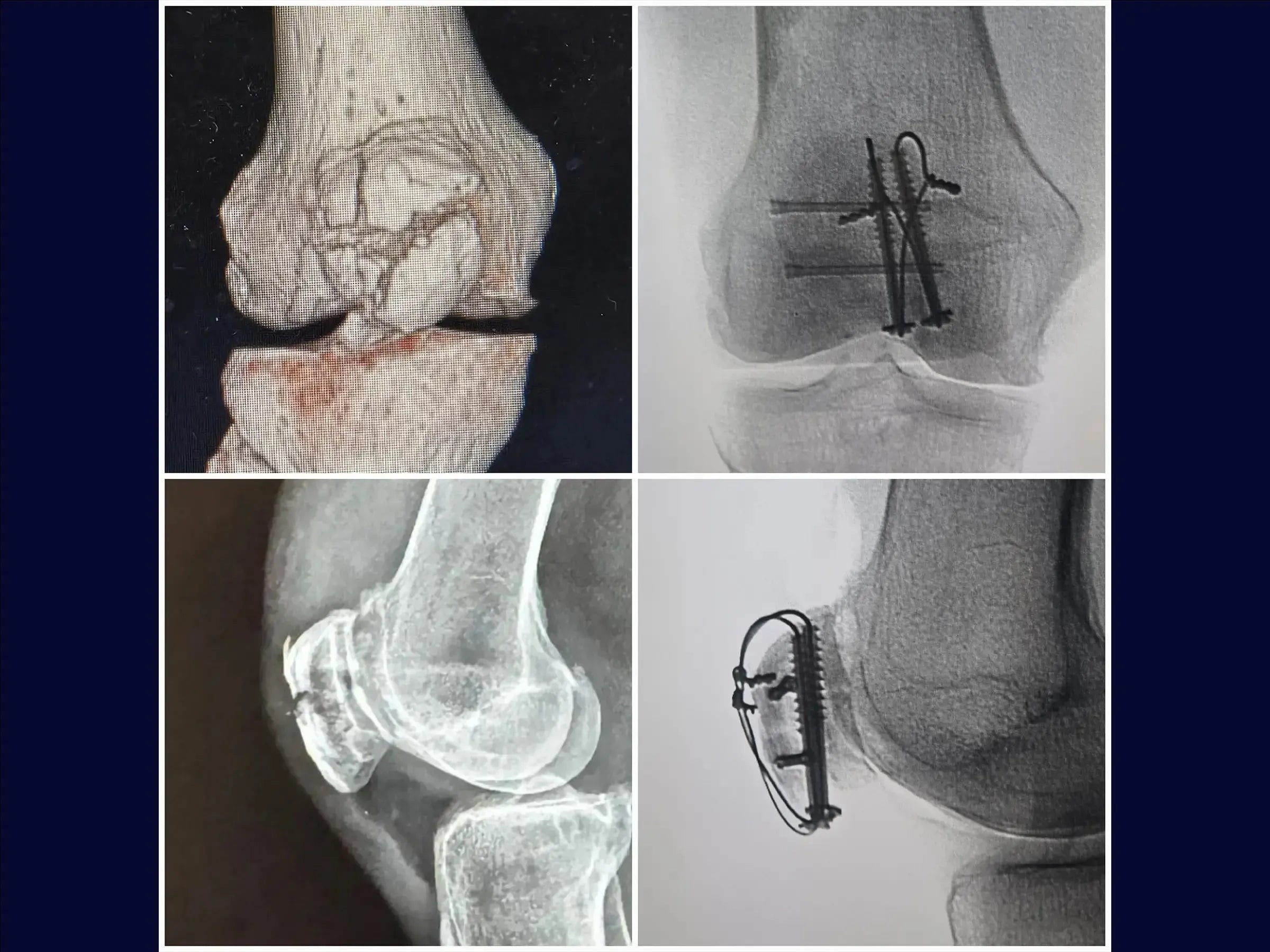 Multi-fragmentary Patella Fracture