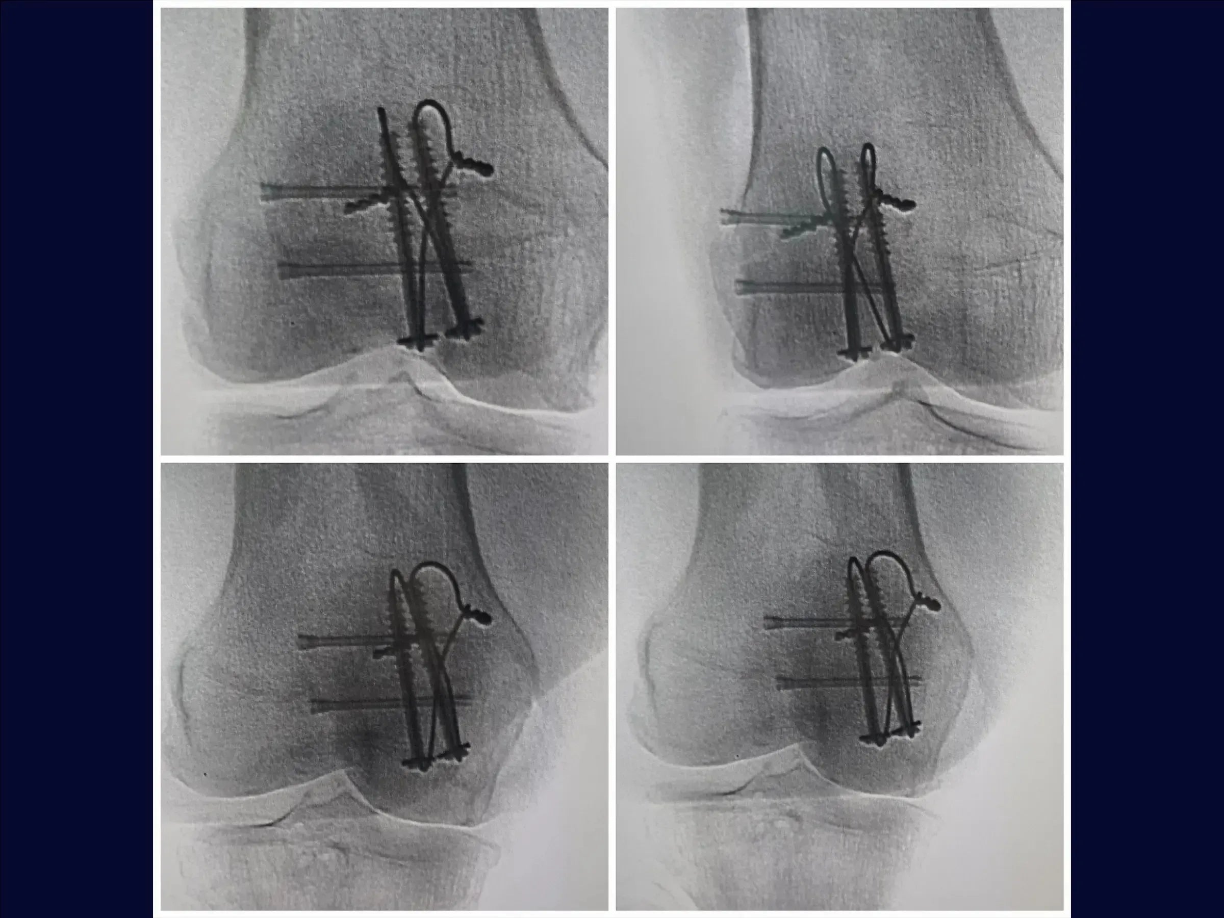Multi-fragmentary Patella Fracture