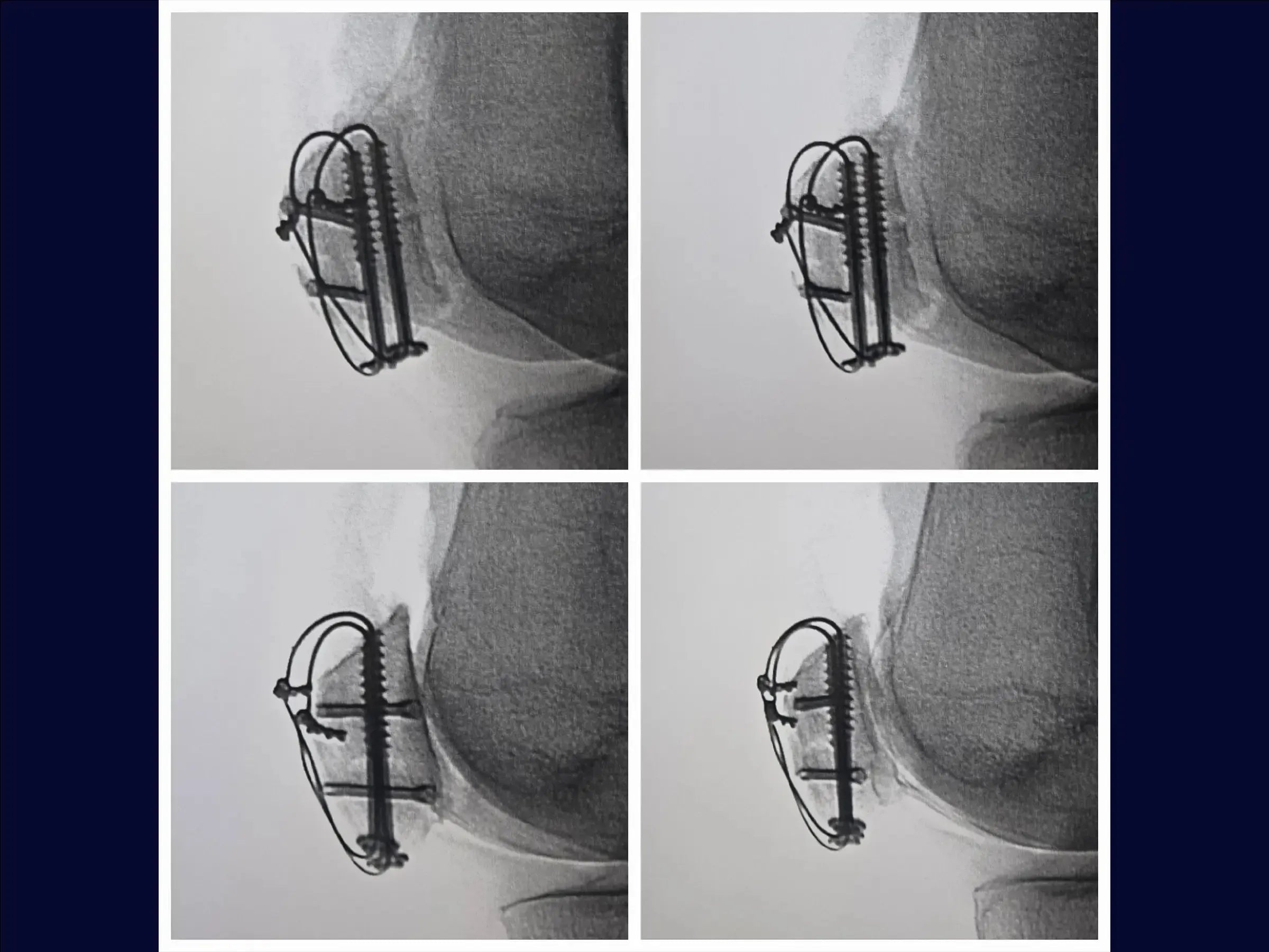 Multi-fragmentary Patella Fracture
