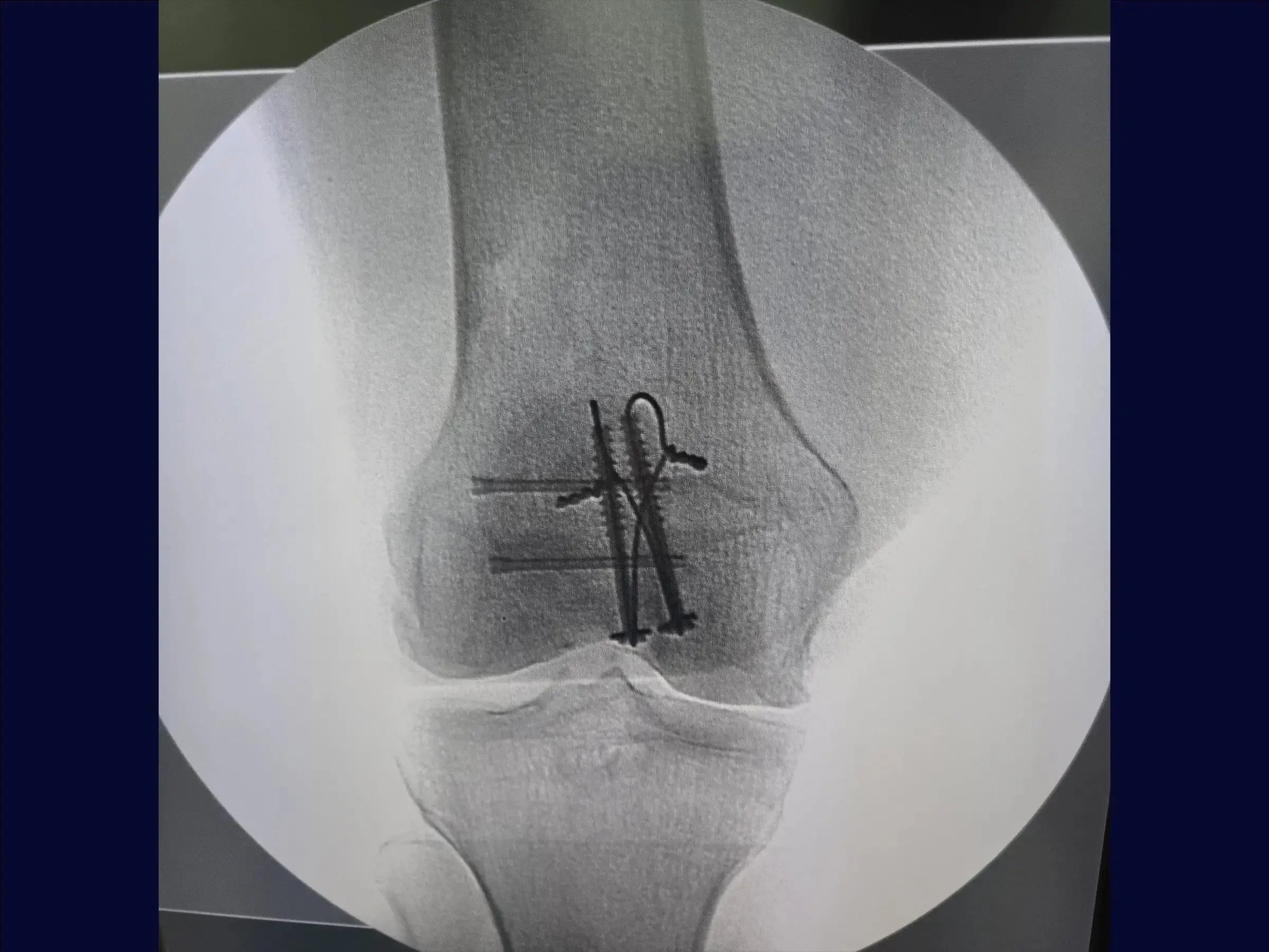 Multi-fragmentary Patella Fracture
