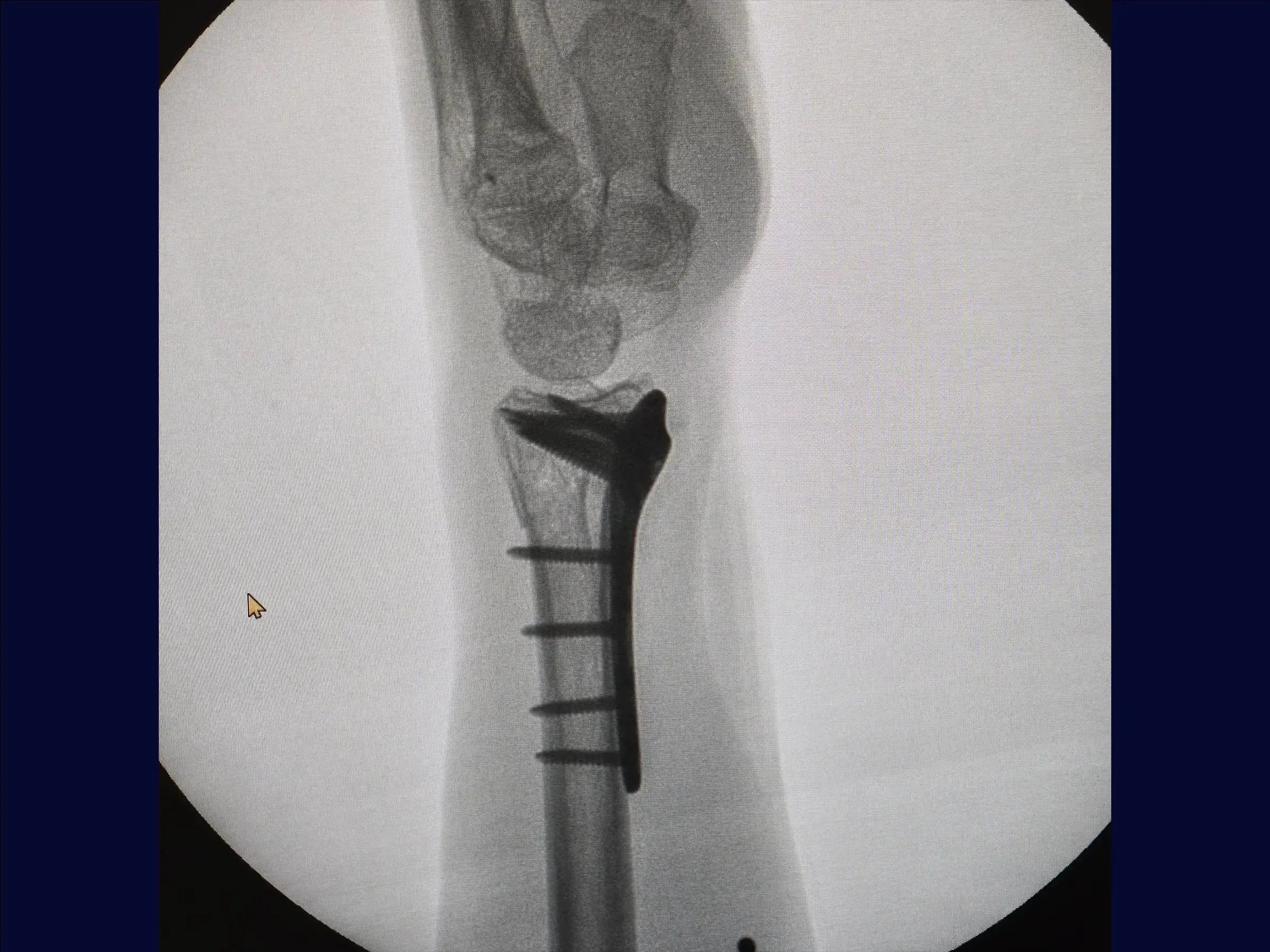 Multifragmentary Distal Radius Fracture (Volar Approach)
