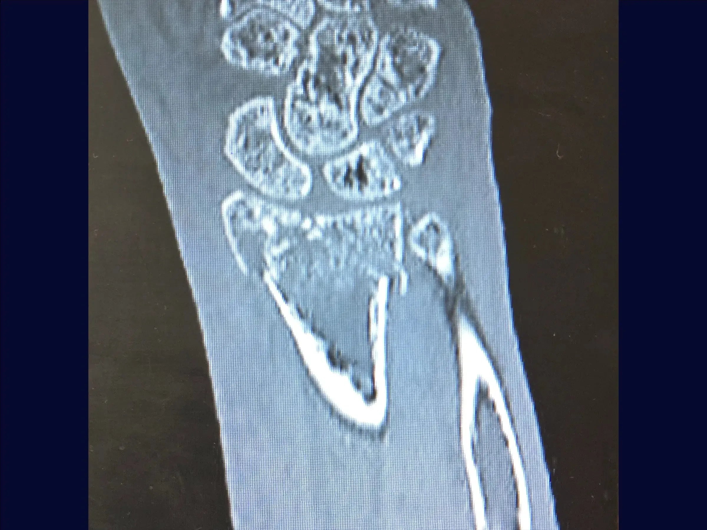 Multifragmentary Distal Radius Fracture (Volar Approach)