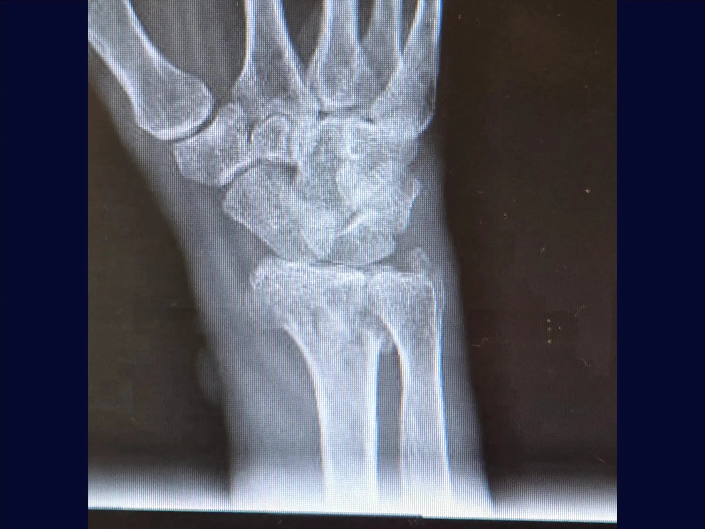 Multifragmentary Distal Radius Fracture (Volar Approach)
