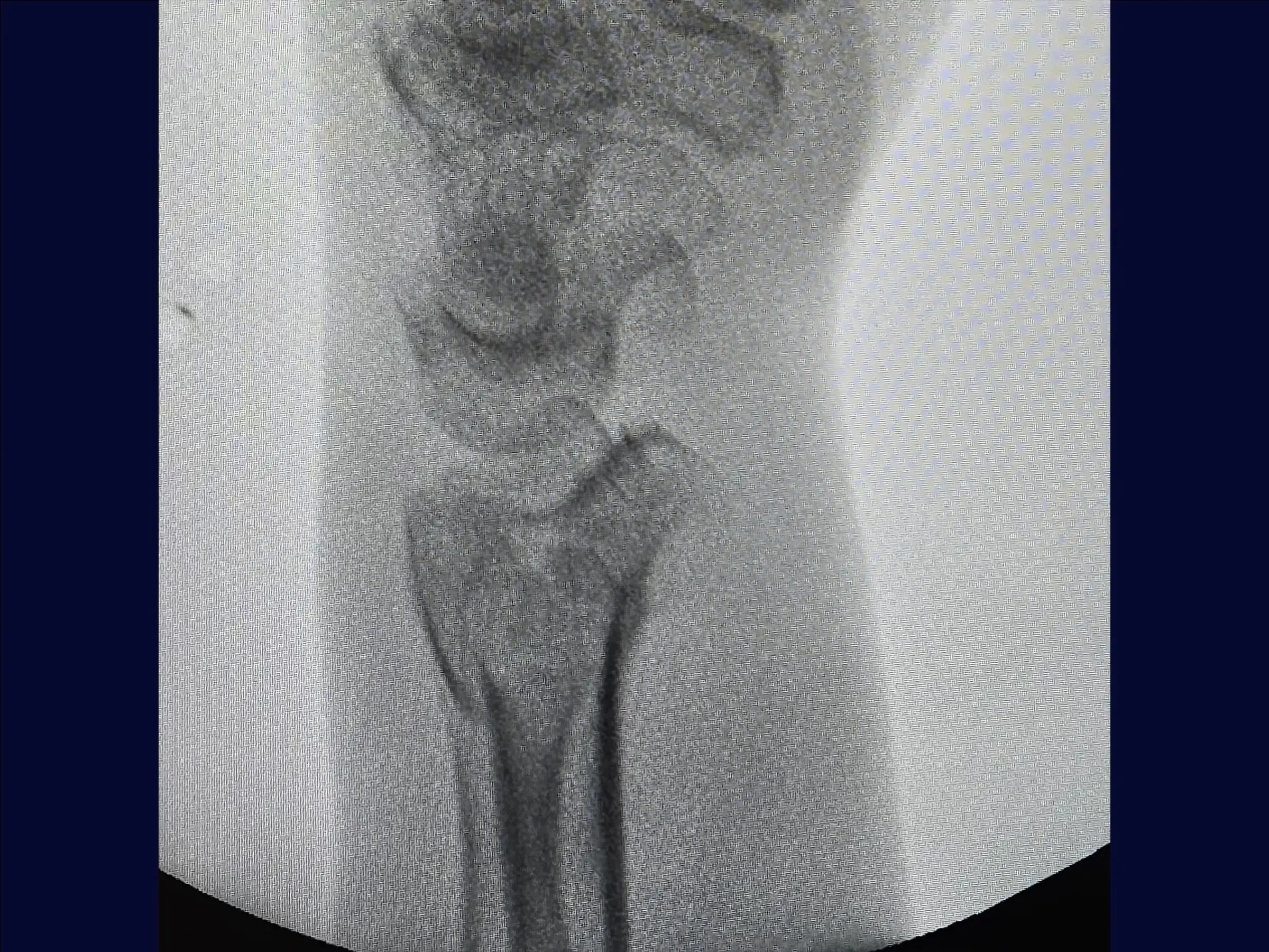 Multifragmentary Distal Radius Fracture (Volar Approach)