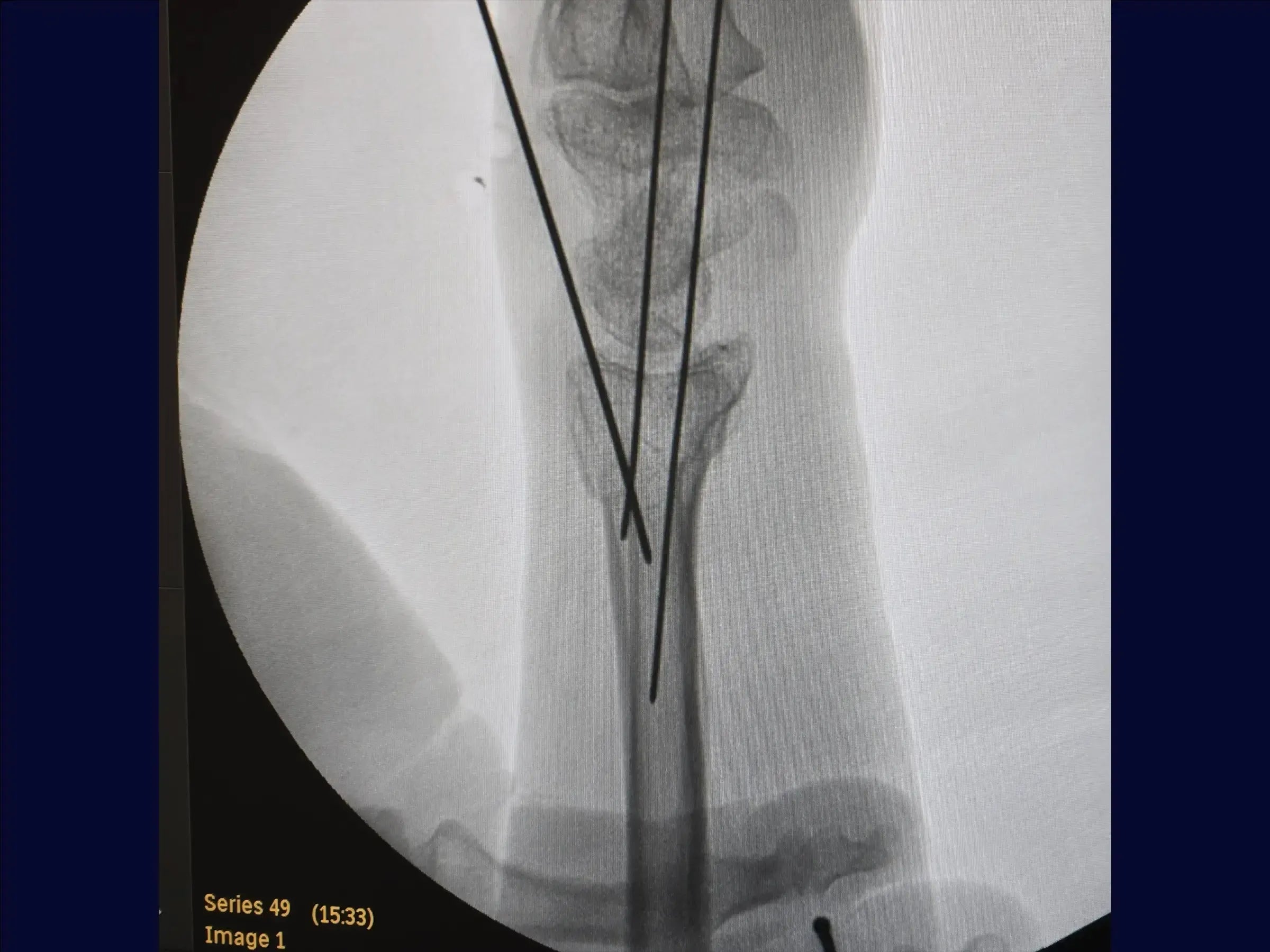 Multifragmentary Distal Radius Fracture (Volar Approach)