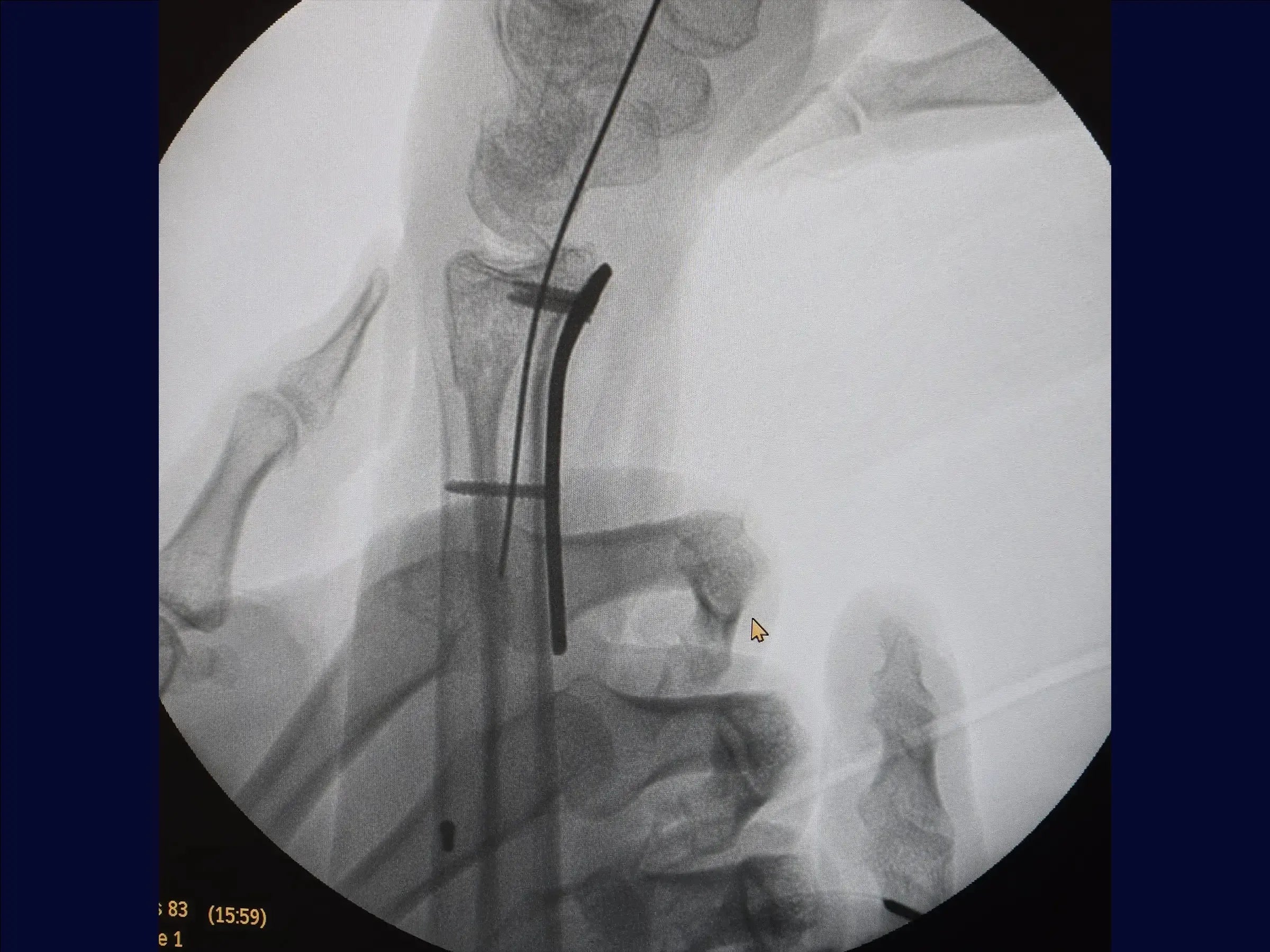 Multifragmentary Distal Radius Fracture (Volar Approach)