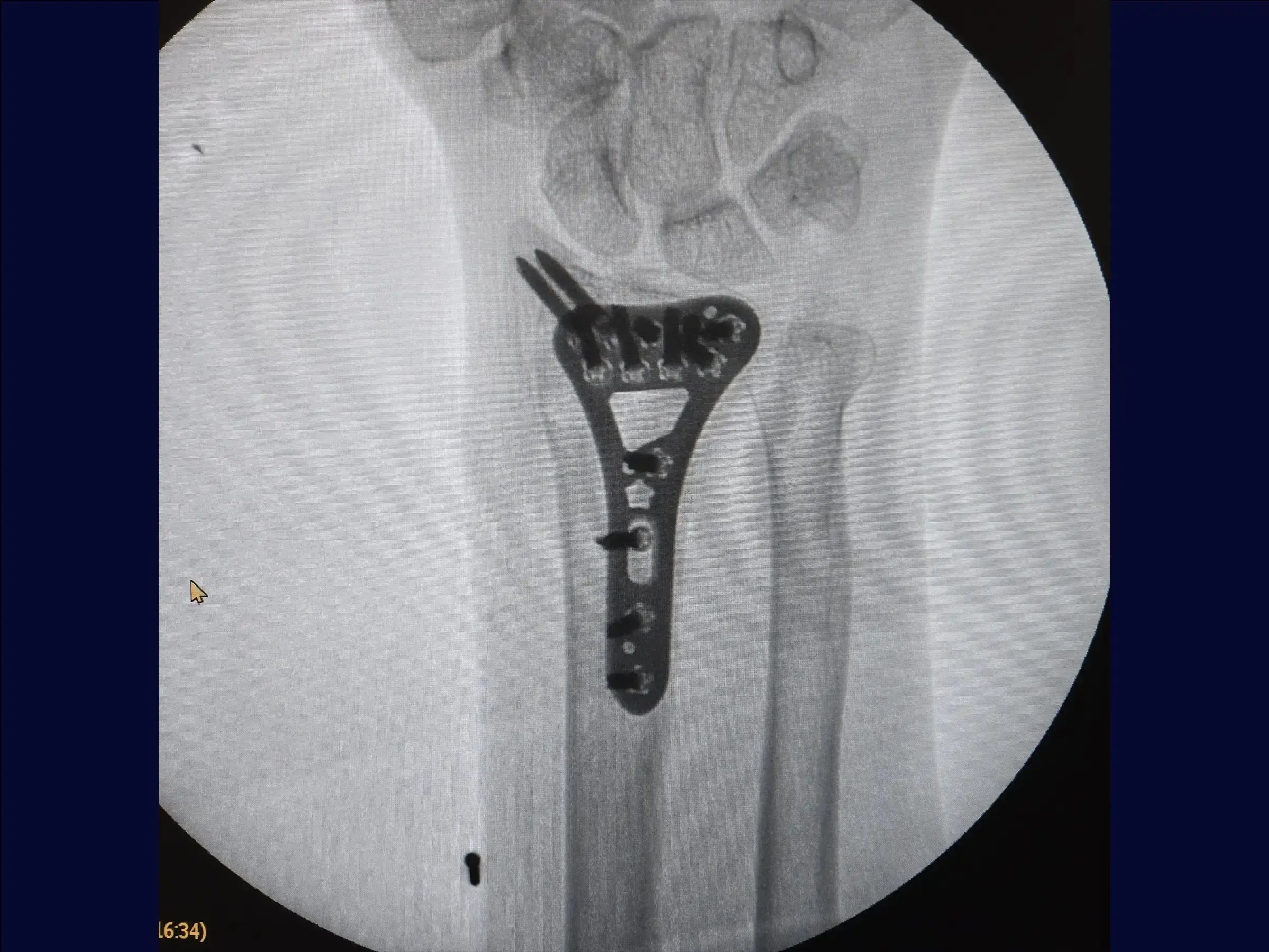 Multifragmentary Distal Radius Fracture (Volar Approach)
