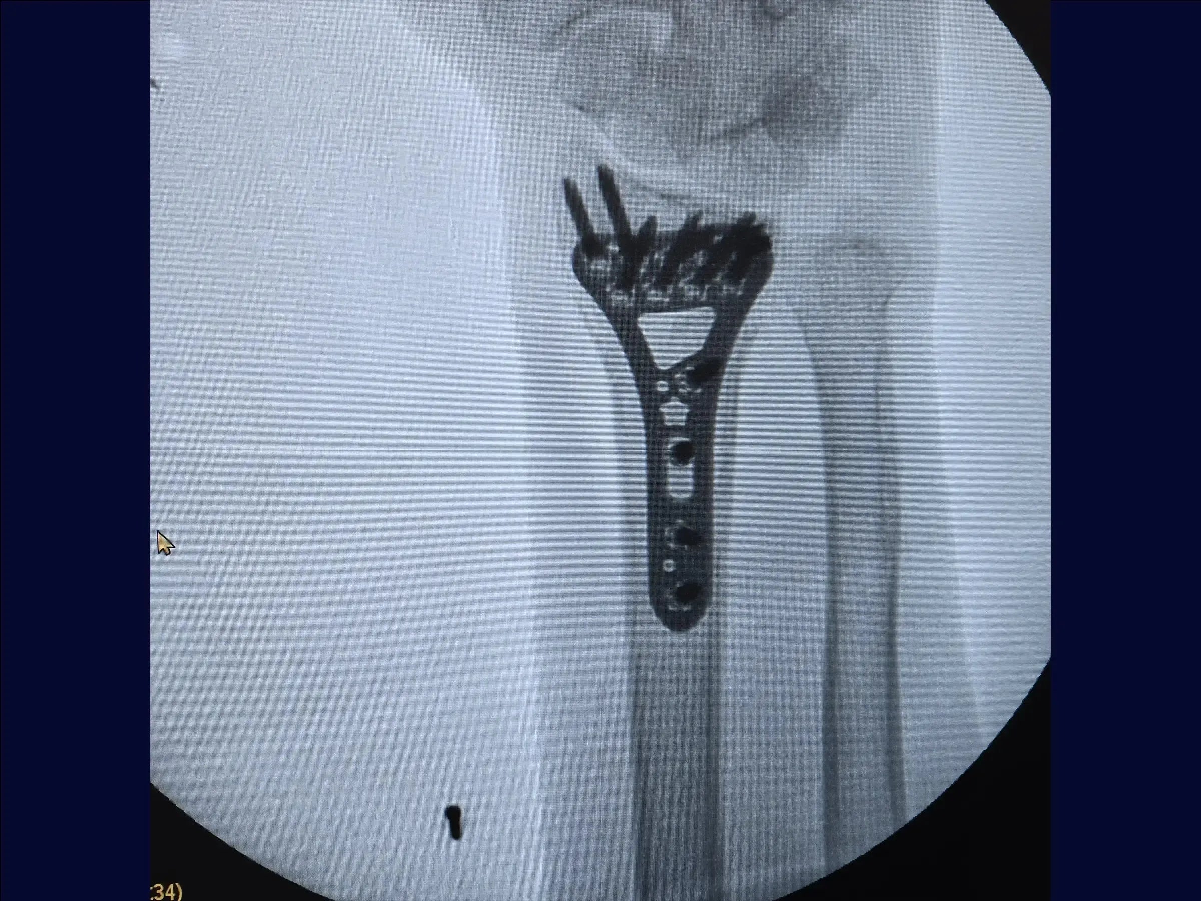 Multifragmentary Distal Radius Fracture (Volar Approach)