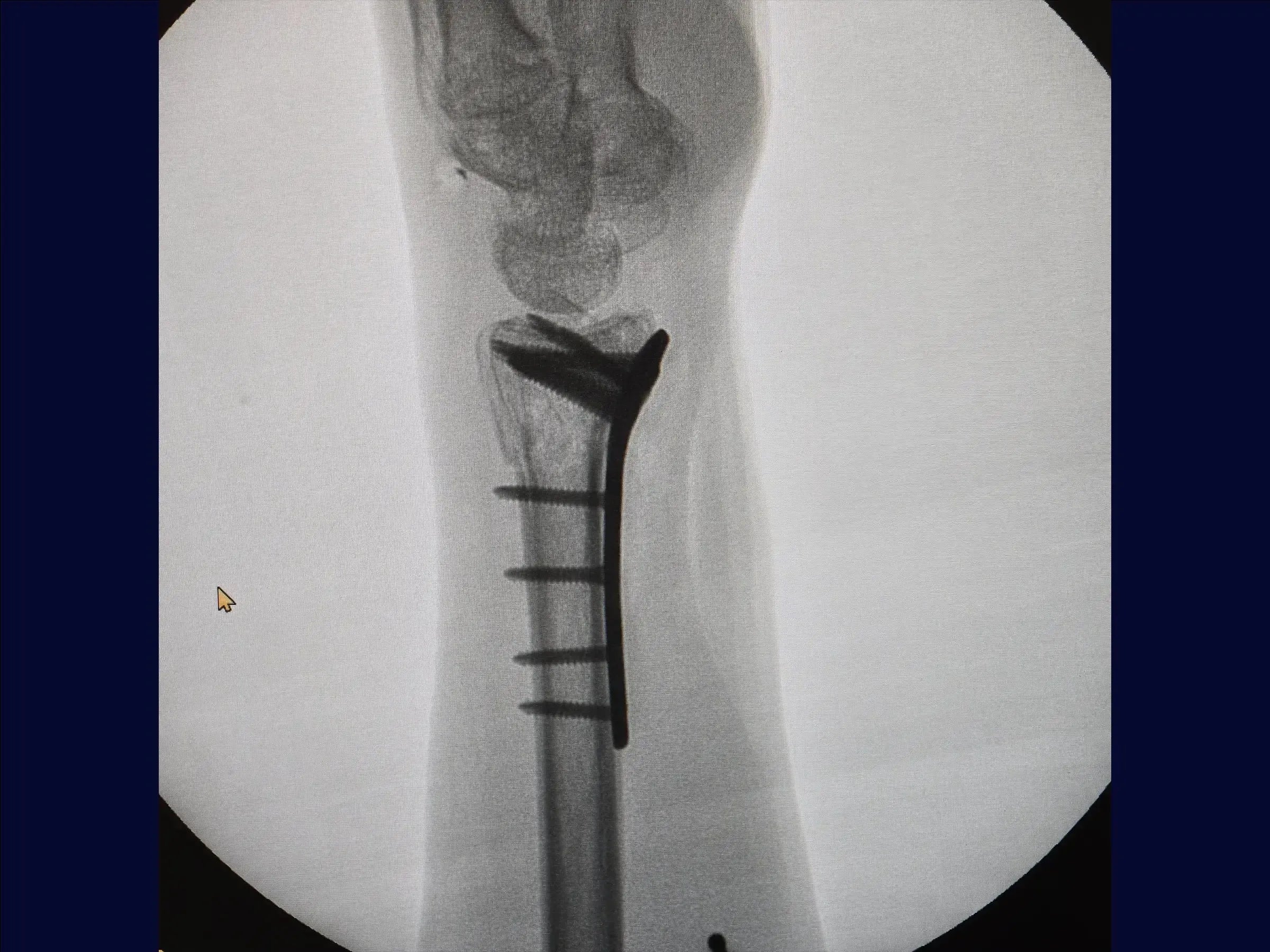 Multifragmentary Distal Radius Fracture (Volar Approach)