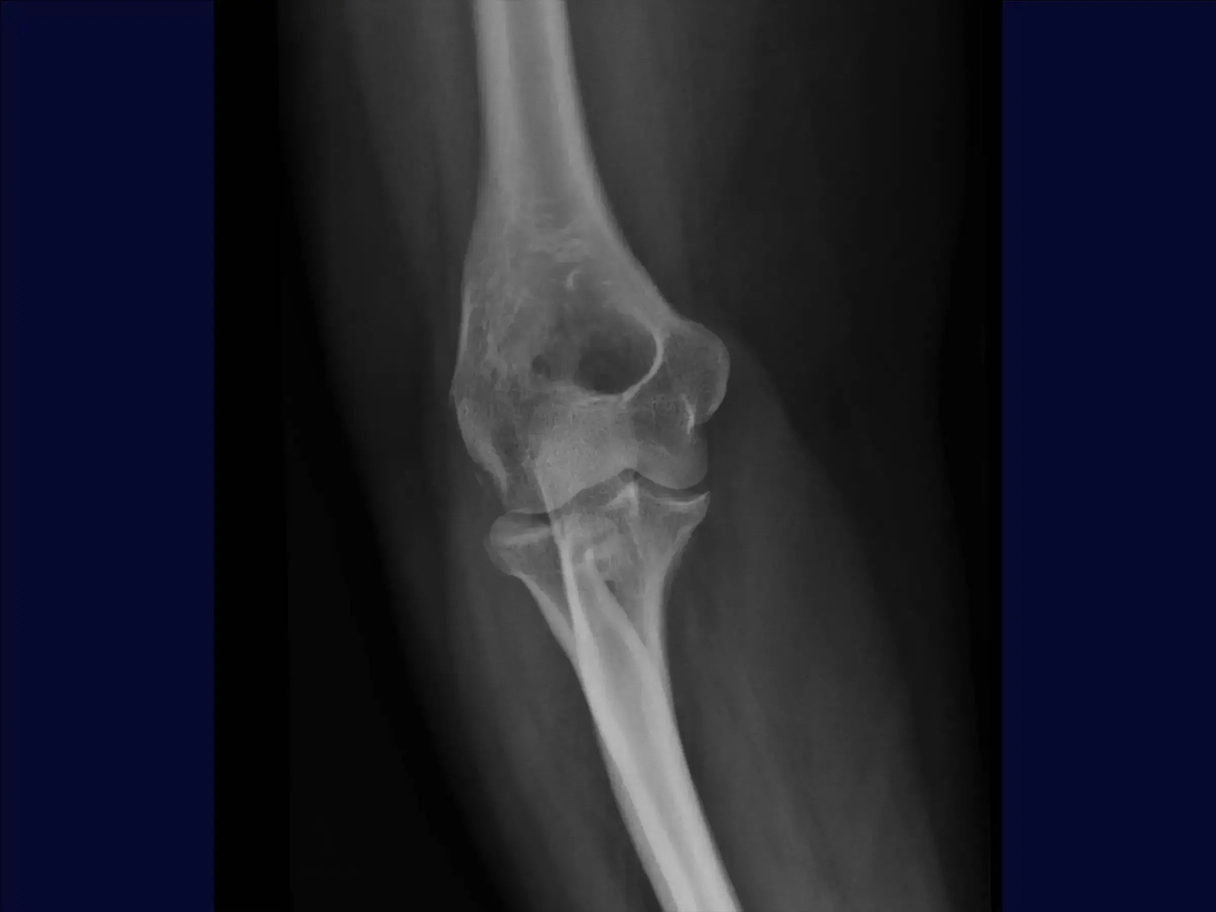 Multifragmentary Radial Head Fracture (Mason 3) with Associated Instability
