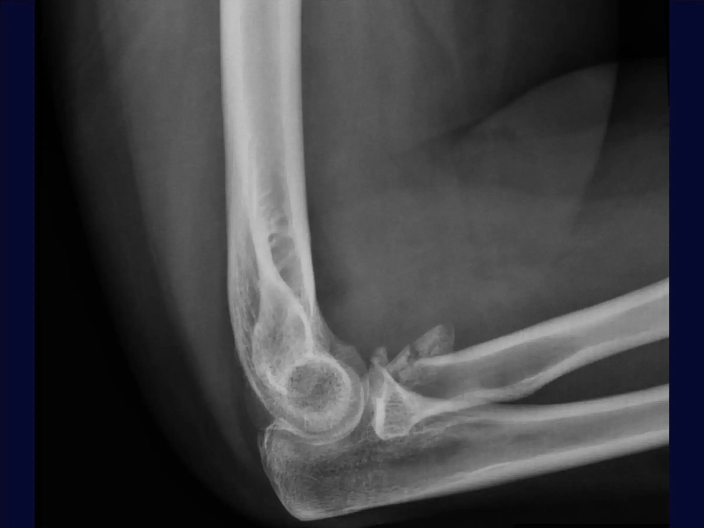 Multifragmentary Radial Head Fracture (Mason 3) with Associated Instability