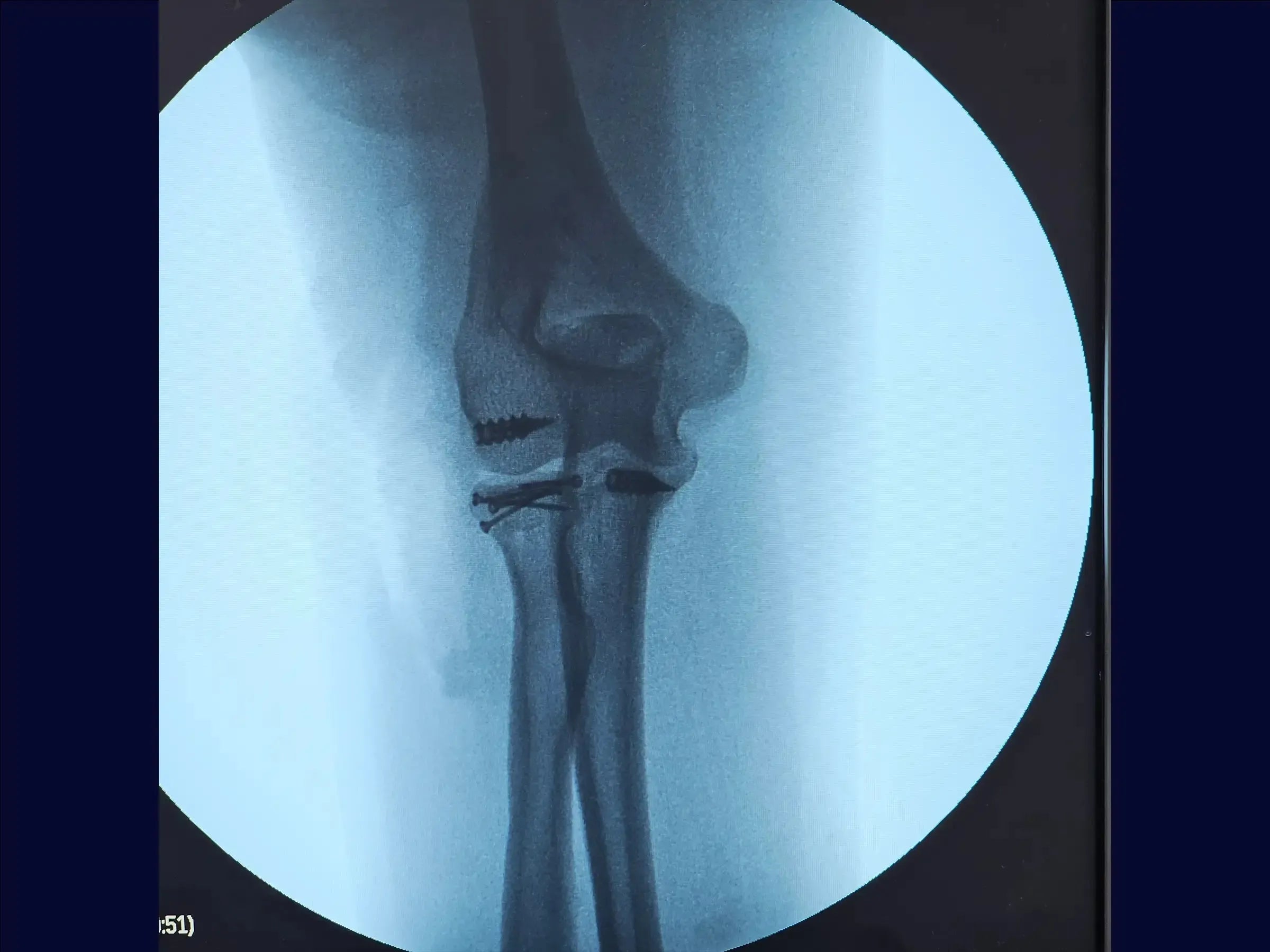 Multifragmentary Radial Head Fracture (Mason 3) with Associated Instability